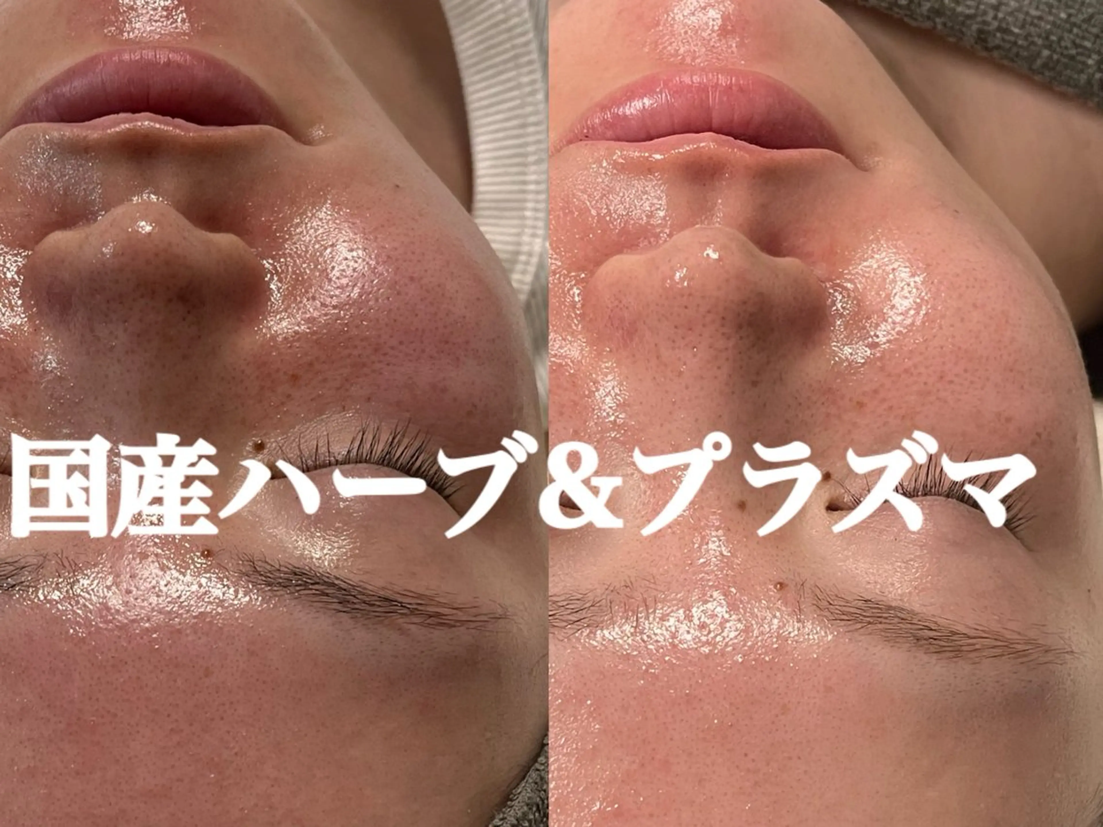 艶爆誕🌿剥けないハーブピーリング／美容液ポレーション導入セットの写真