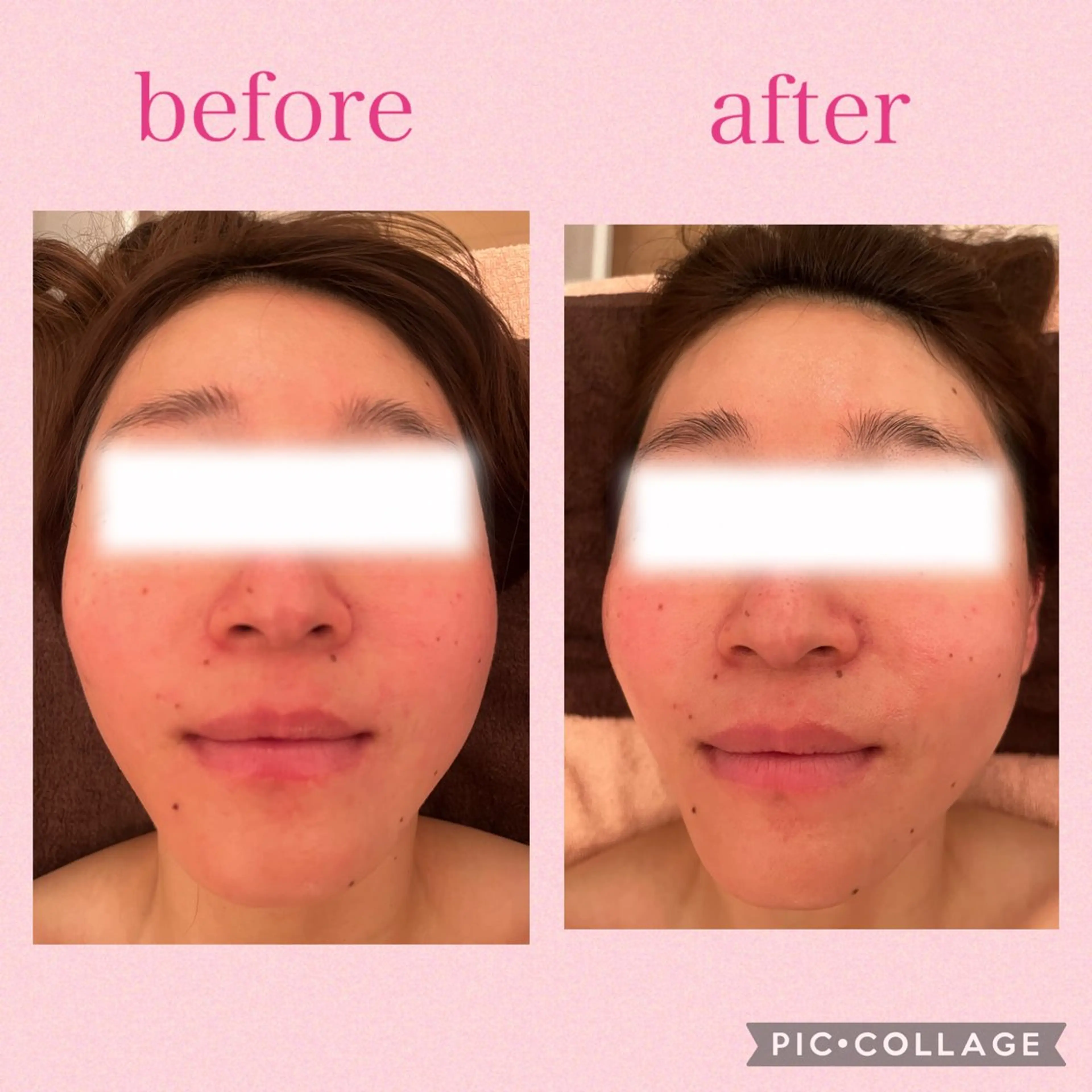 3/25迄ハーブ ピーリングBloomのエステ・リラクイメージ