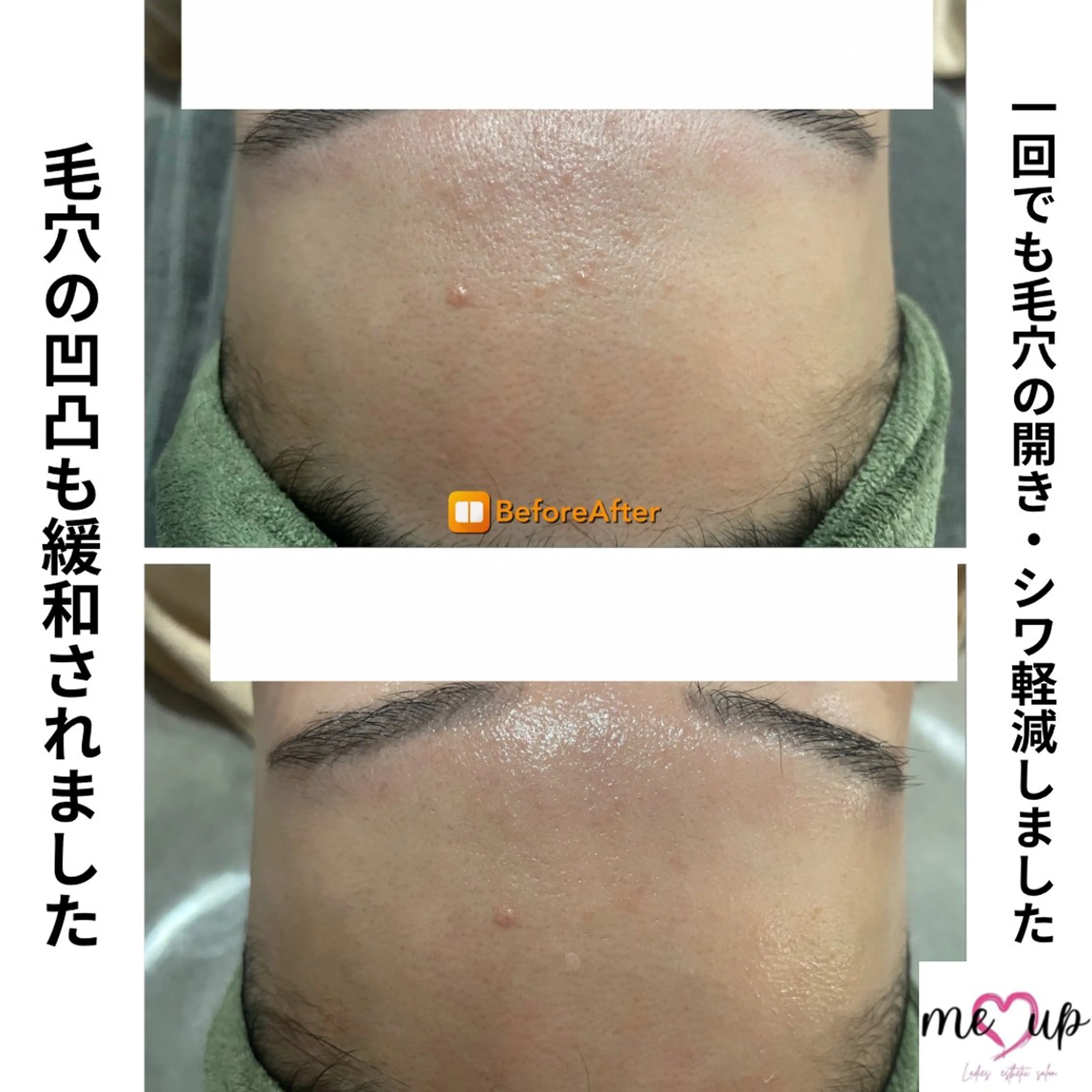 エステ Meupニキビ専門店 背中/ハーブ/肌管理のその他イメージ