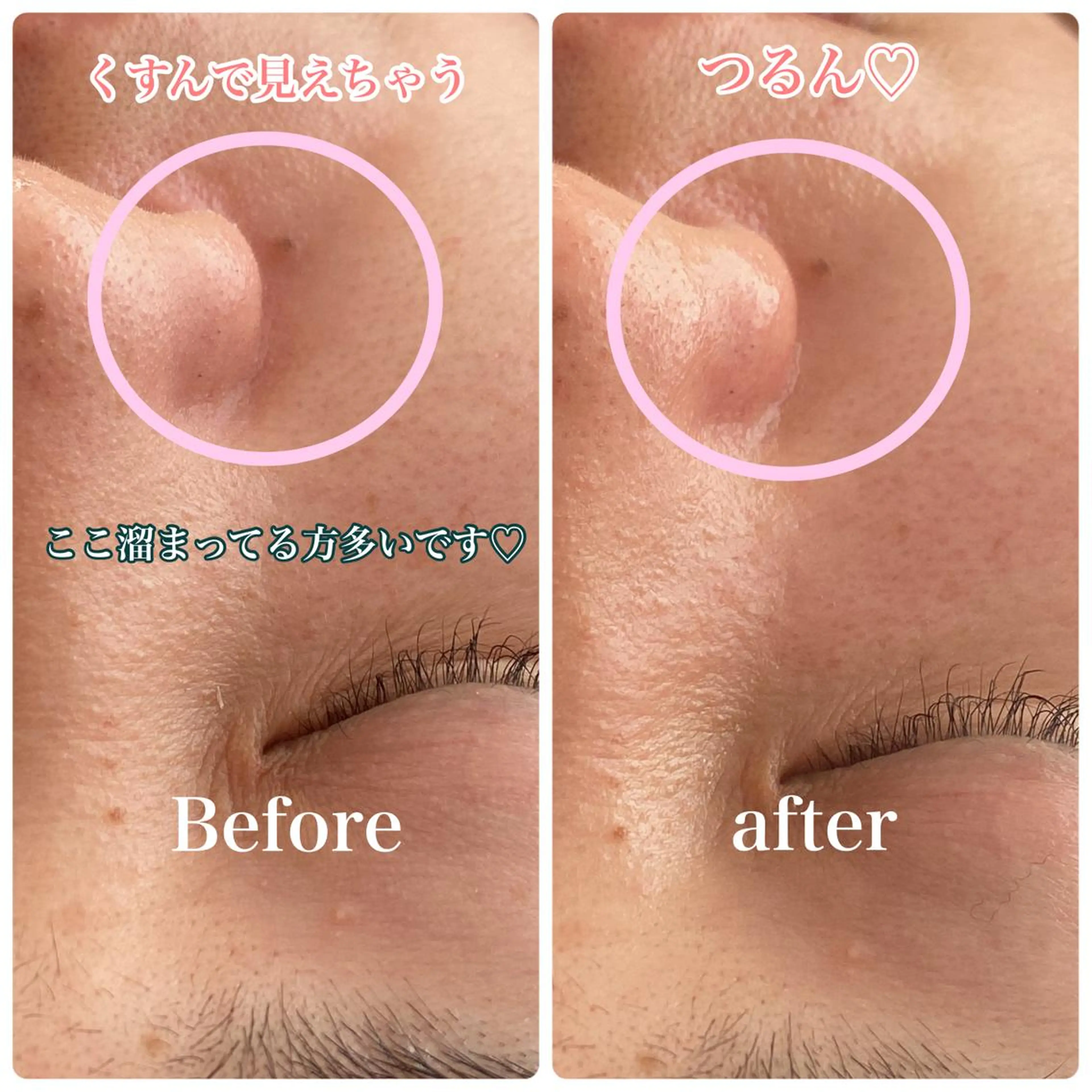 REVI取扱・肌悩み 毛穴Chalonのエステ・リラクイメージ