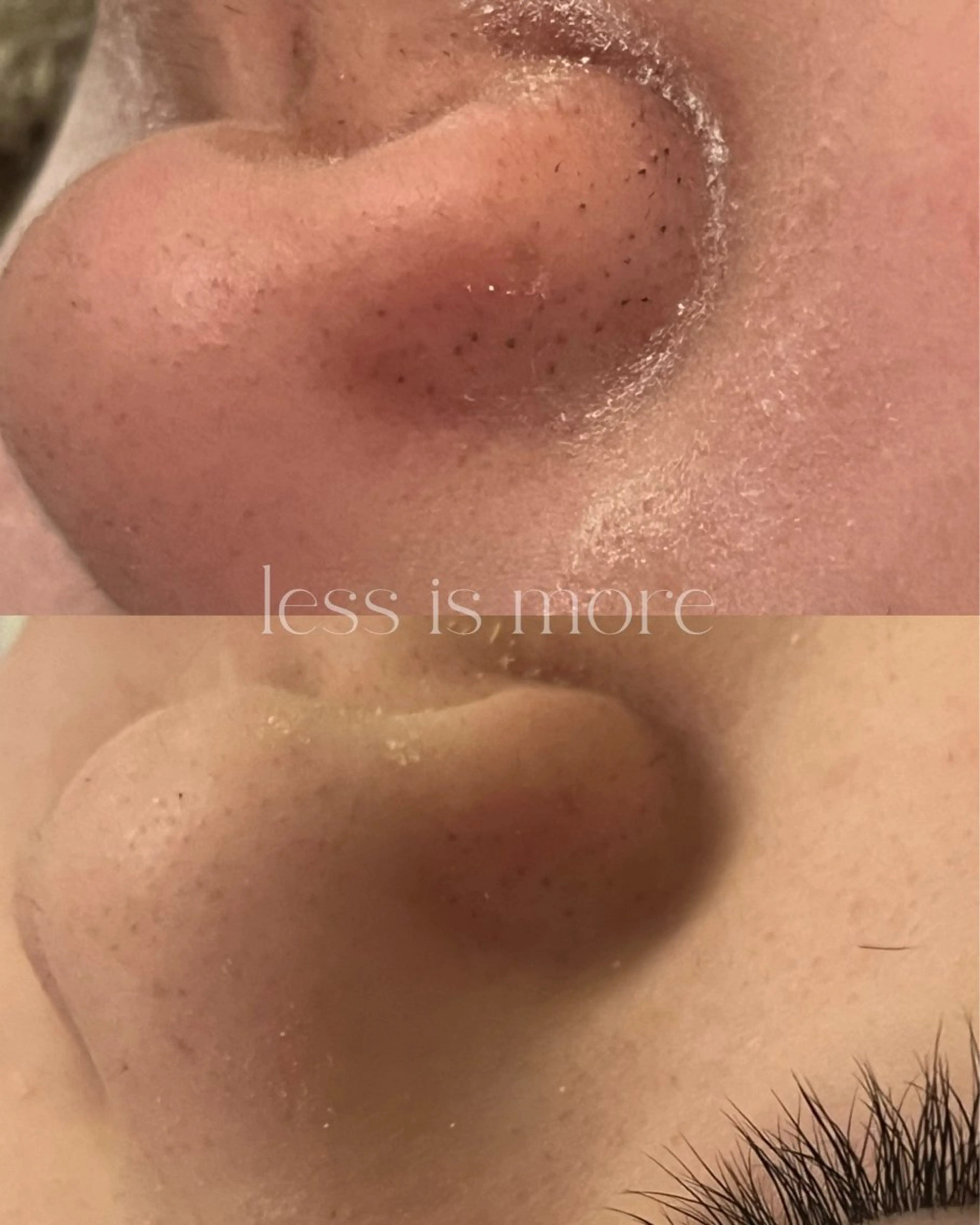 毛穴【毛穴ケア】金の糸顔脱毛✨産毛ケア＋毛穴引き締めの写真