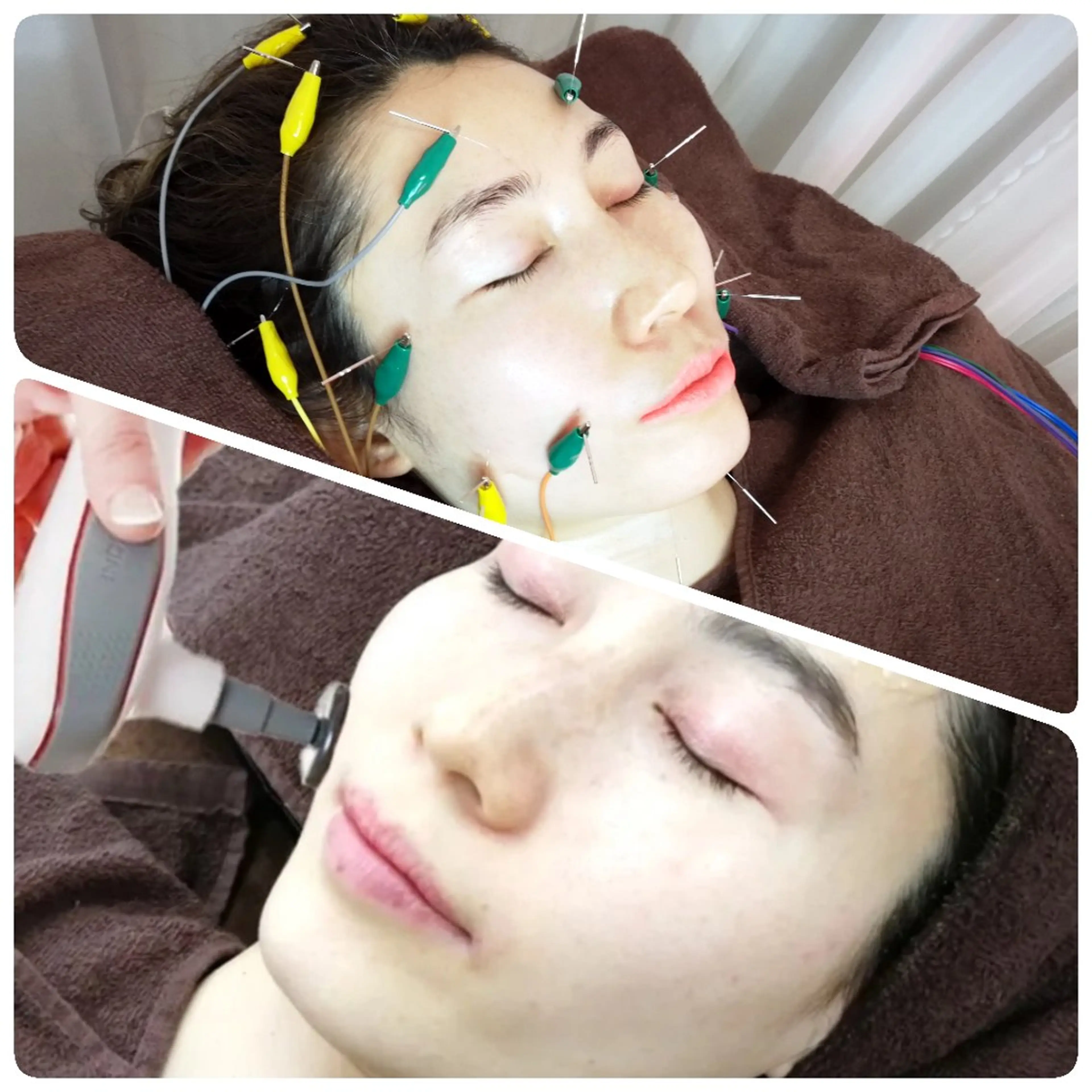 【とにかく小顔・むくみ・エラ】ラジオ波フェイシャル🔥+20ヶ所電気美容鍼⚡🪡【ニューハーフ鍼灸師の最強肌管理🌹】の写真