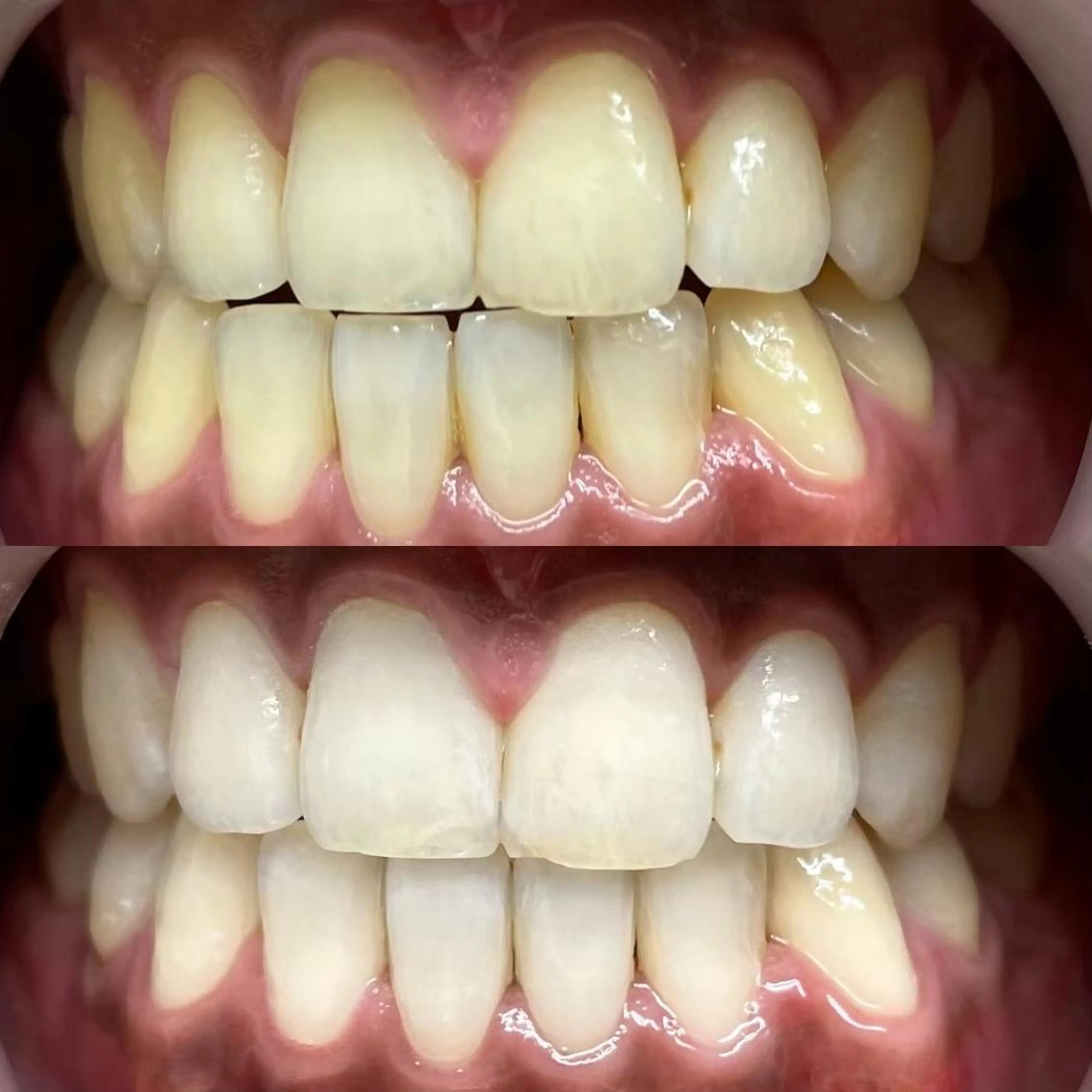 その他 LBSホワイトニング 🌸梅田店公式のその他イメージ