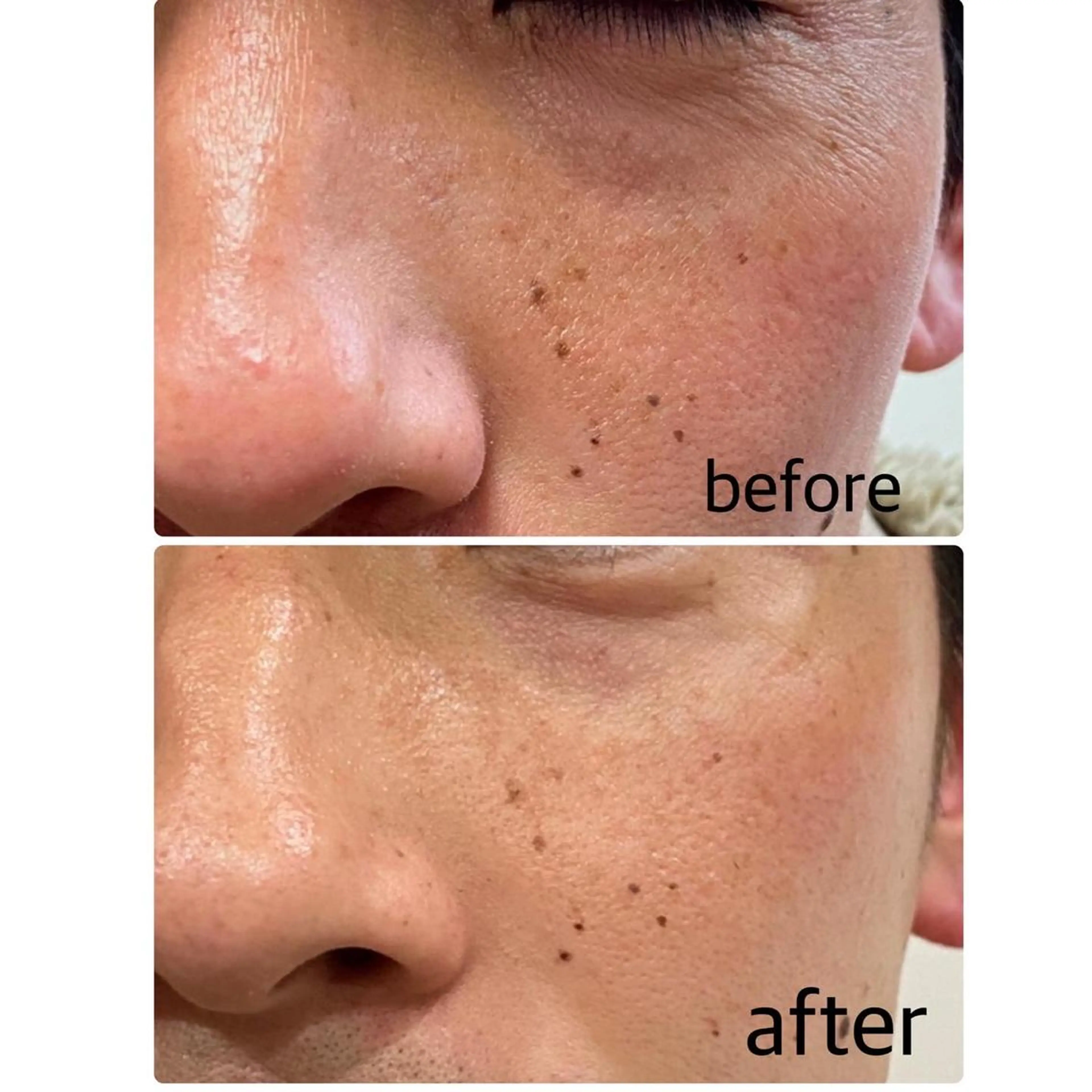 メンズフェイシャルコース✨天然ミネラルベースの角質ケアでさっぱりツルツルの仕上がりに^_^の写真