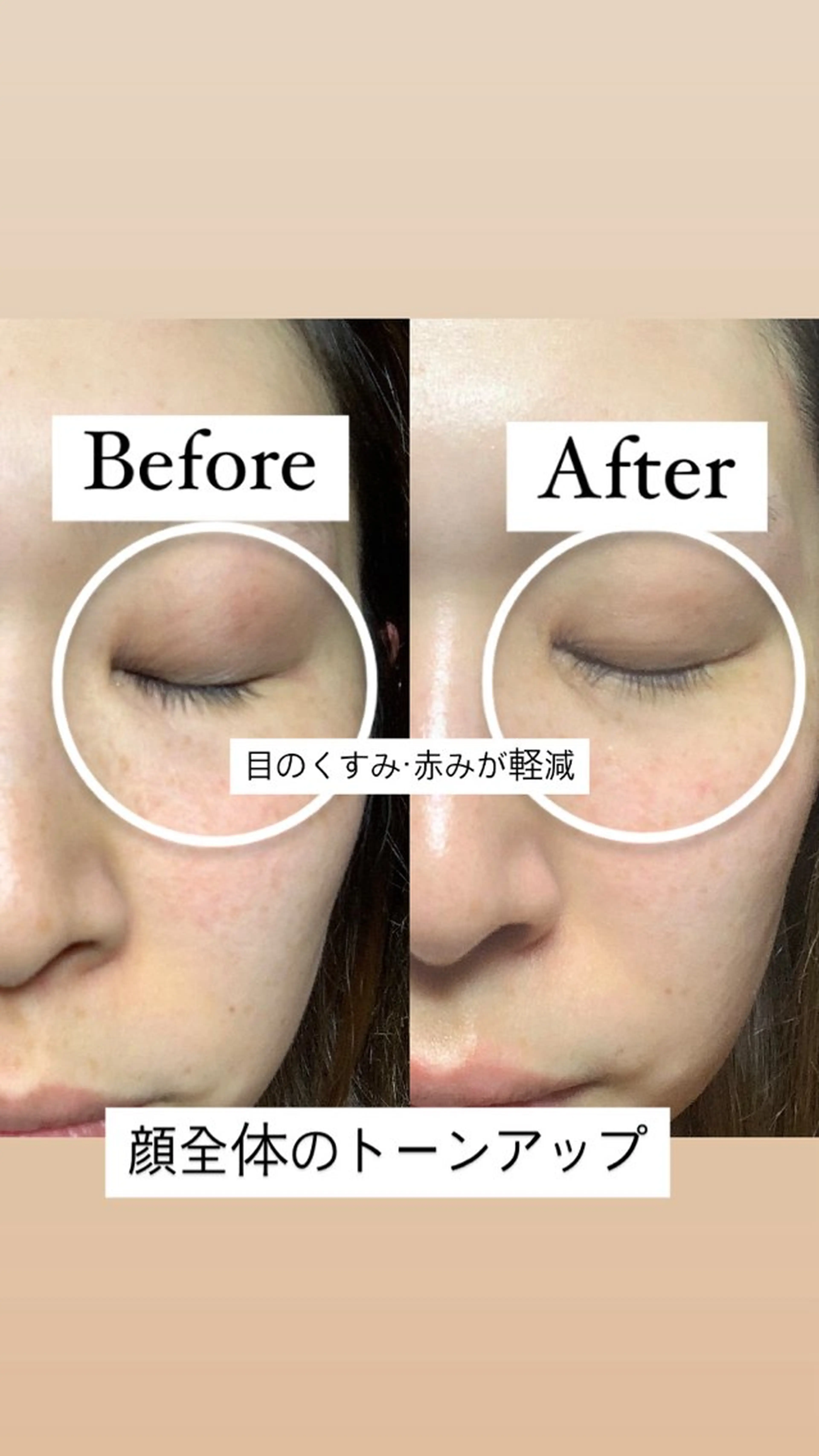 深美白エステ シミ・ソバカスが気になる方にお勧め💎の写真