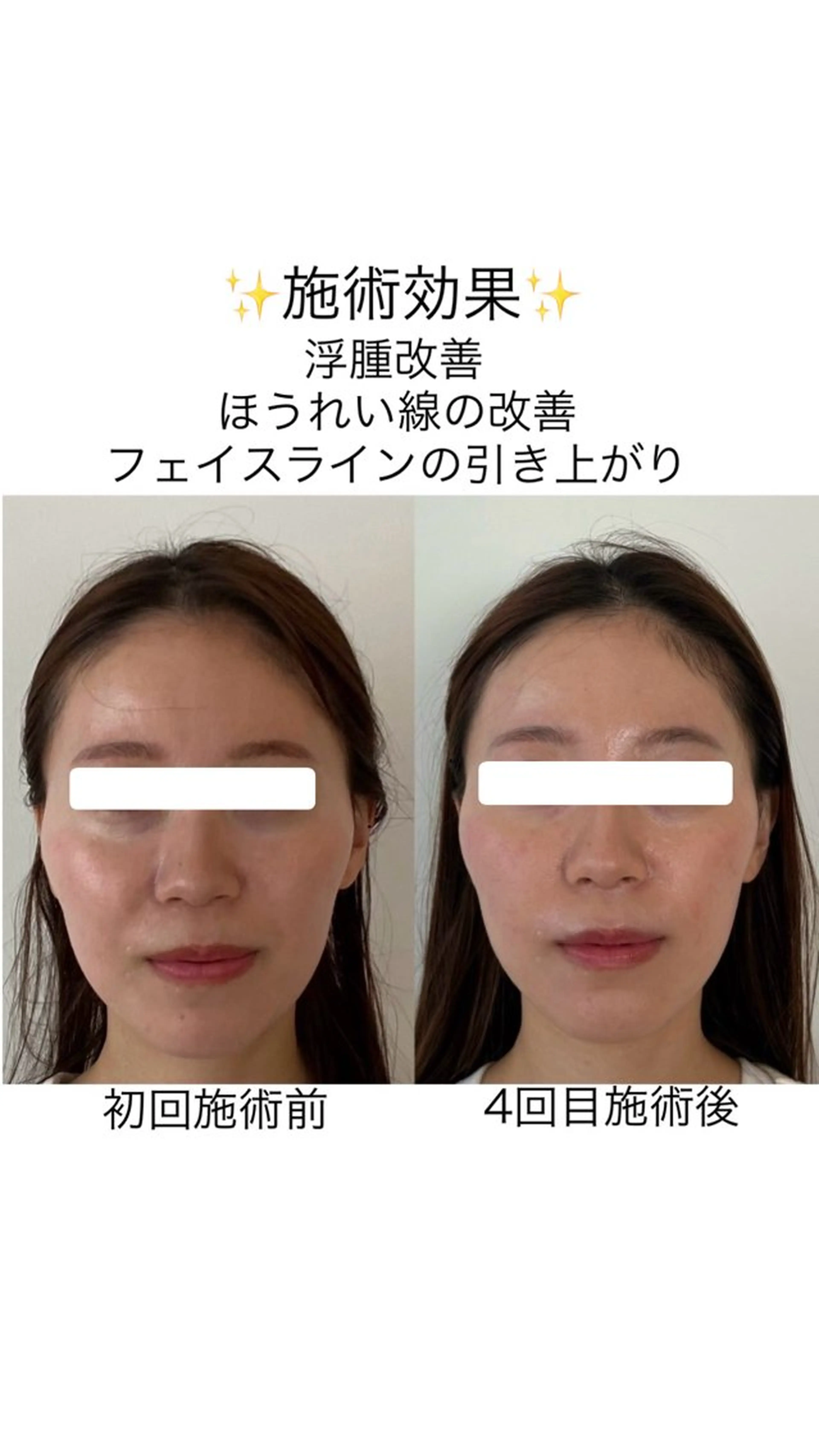 全身整体＋小顔矯正＋美容鍼の写真