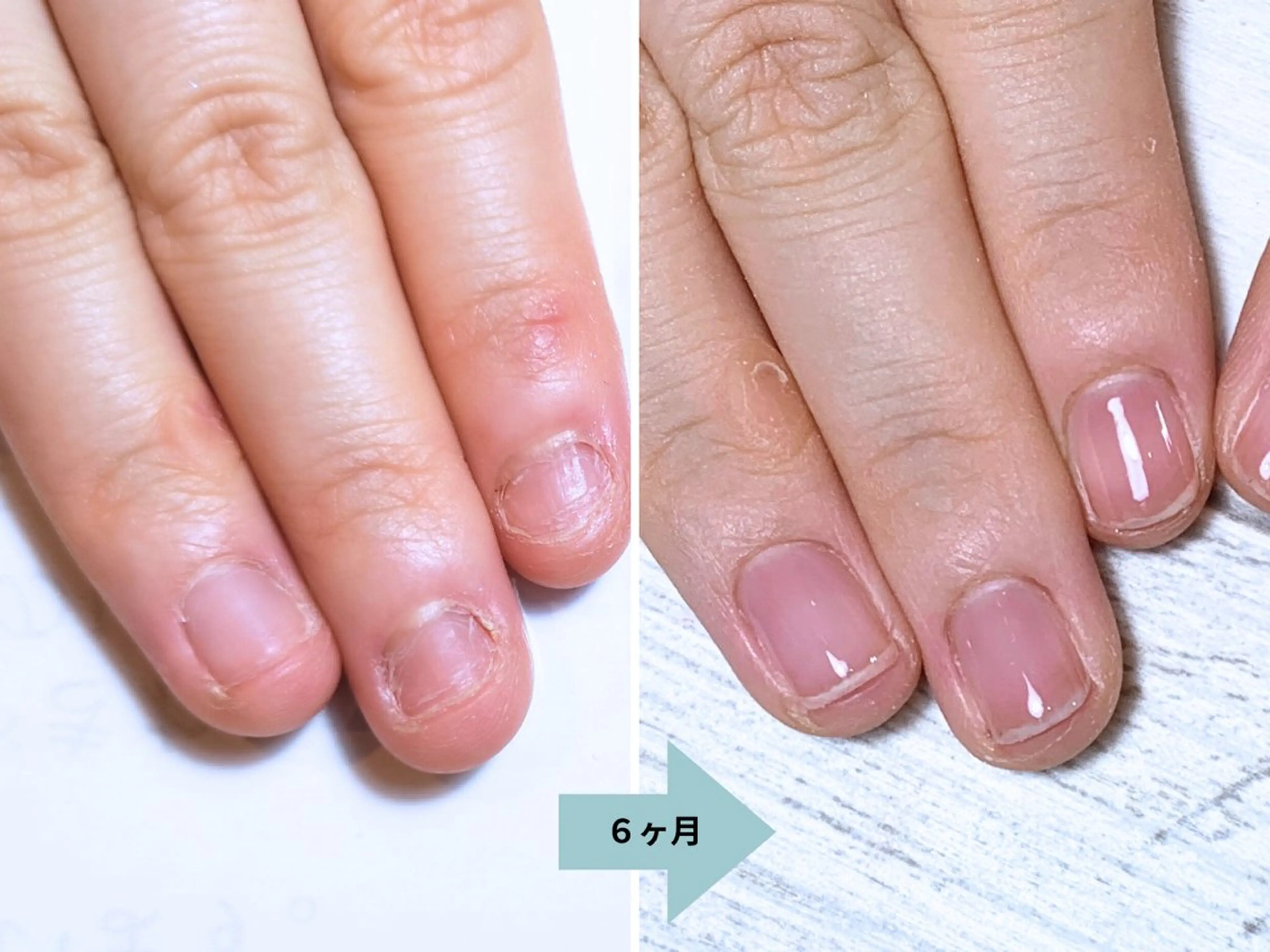 ネイル 深爪矯正・自爪育成 ネイルサロンアモここのネイルデザイン