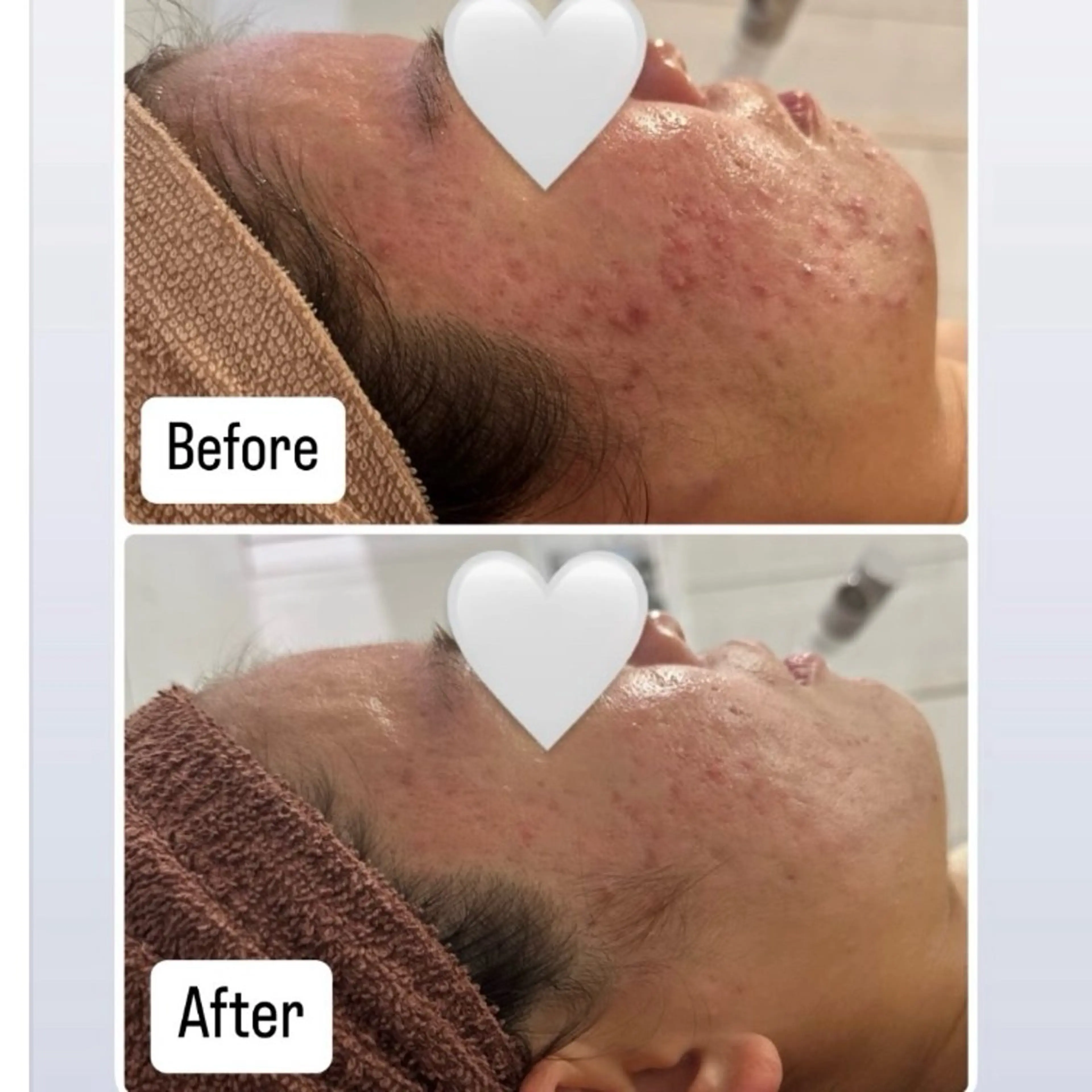 【トレンド美容✨】エクソームピーリング💎の写真