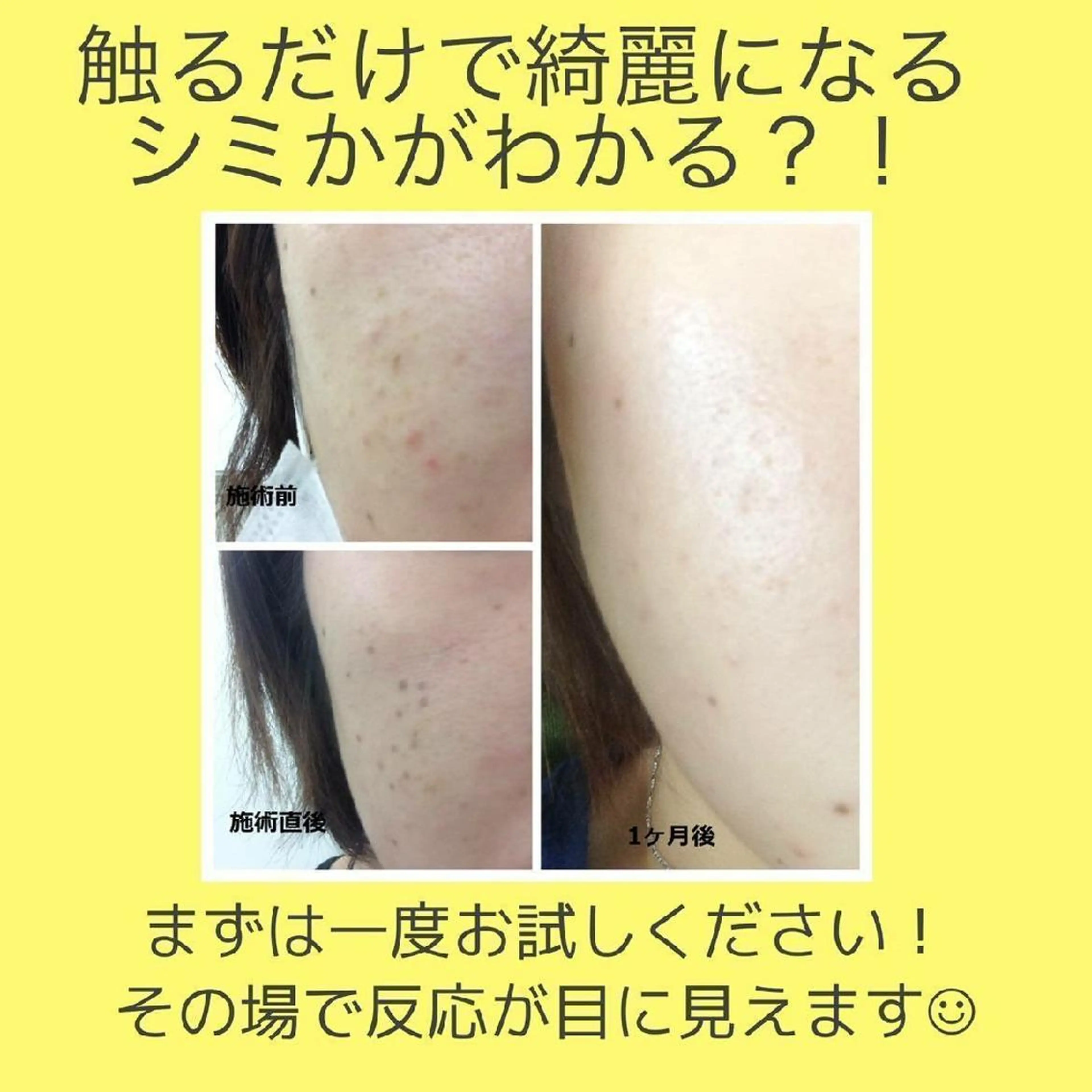 ⭐期間限定⭐シミケアプレミアムコースの写真