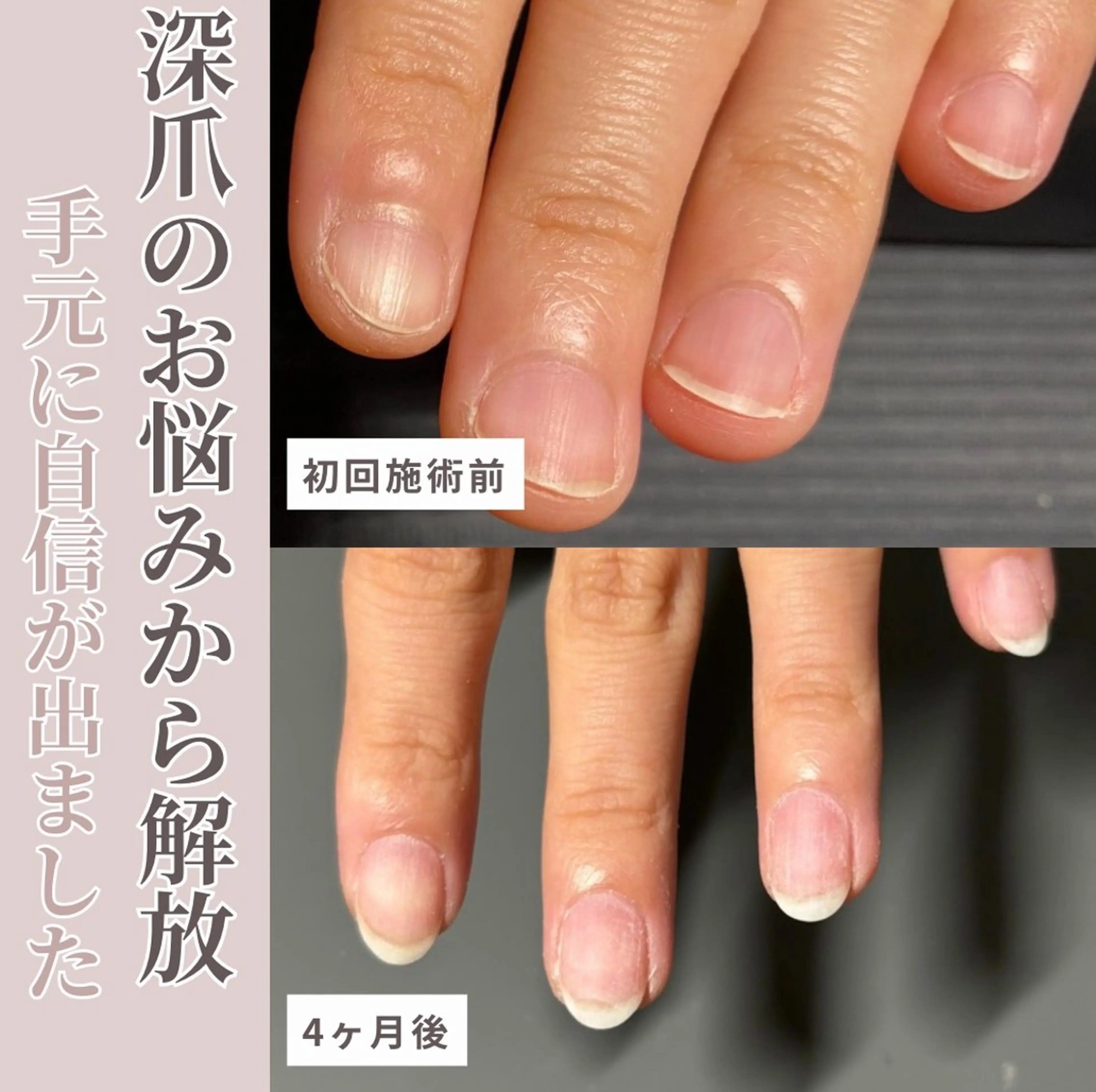 第2期【モニター募集】深爪矯正/自爪育成【ハンド】の写真