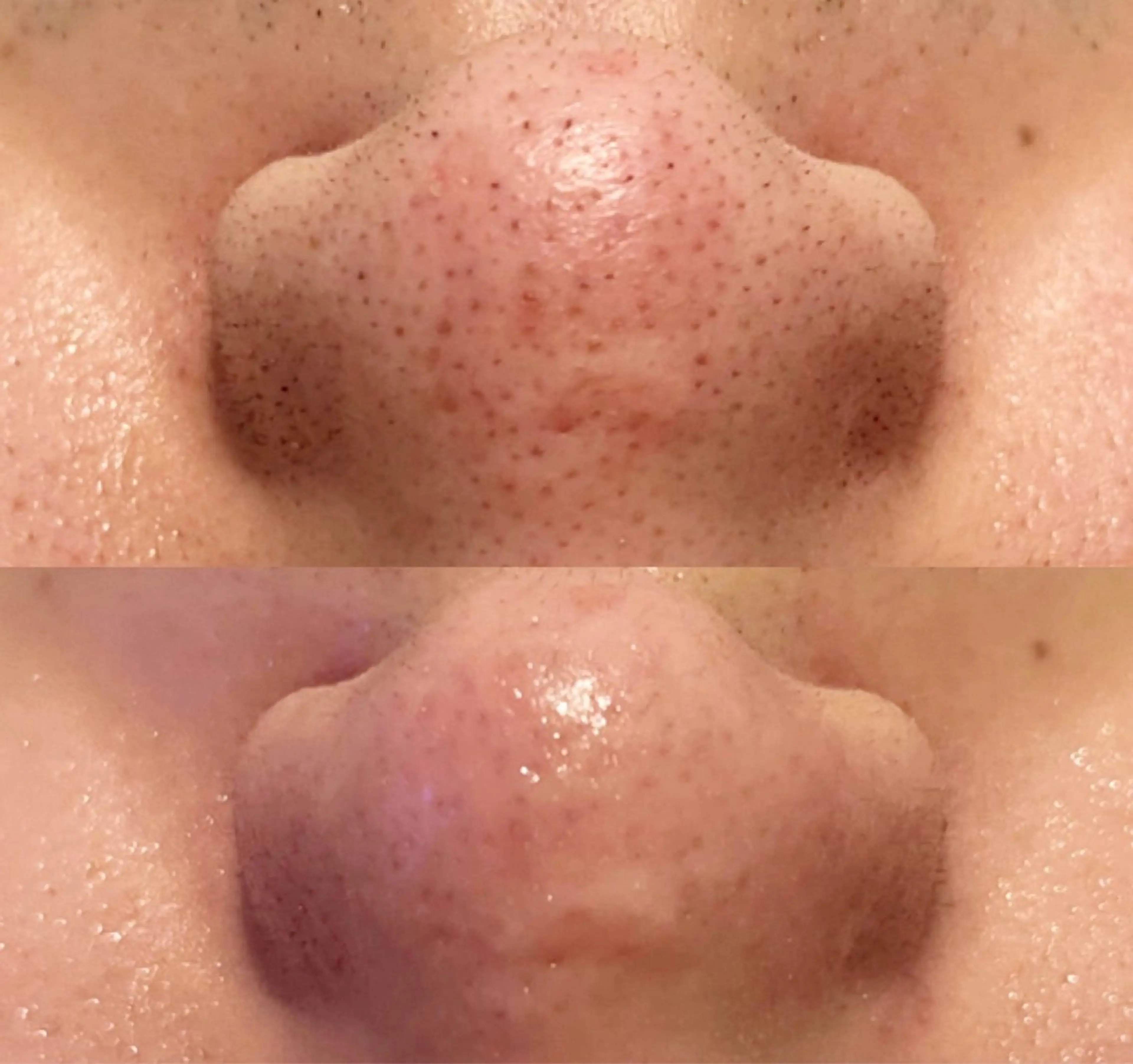 【ハイドロスプラッシュ】 いちご鼻/黒ずみ/角栓/毛穴撃退ケアの写真