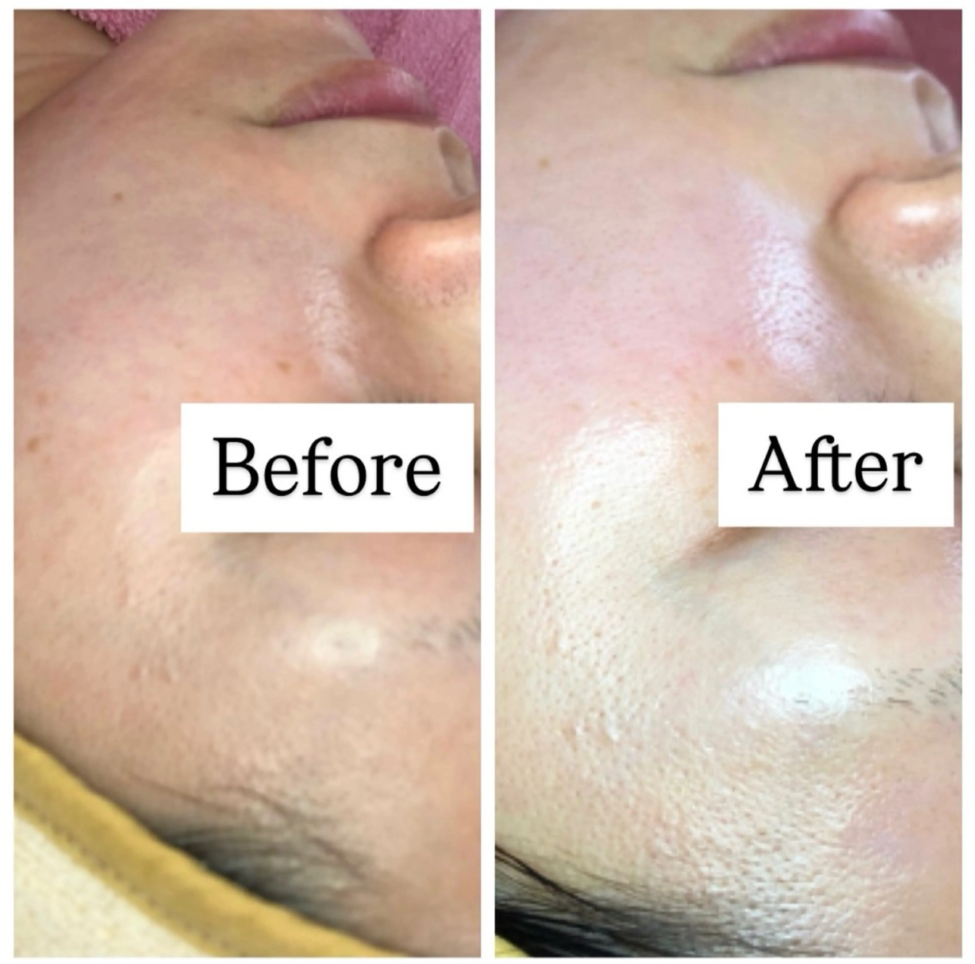 エステ ニキビ/敏感肌/乾燥 Lilyauraのエステ・リラクイメージ