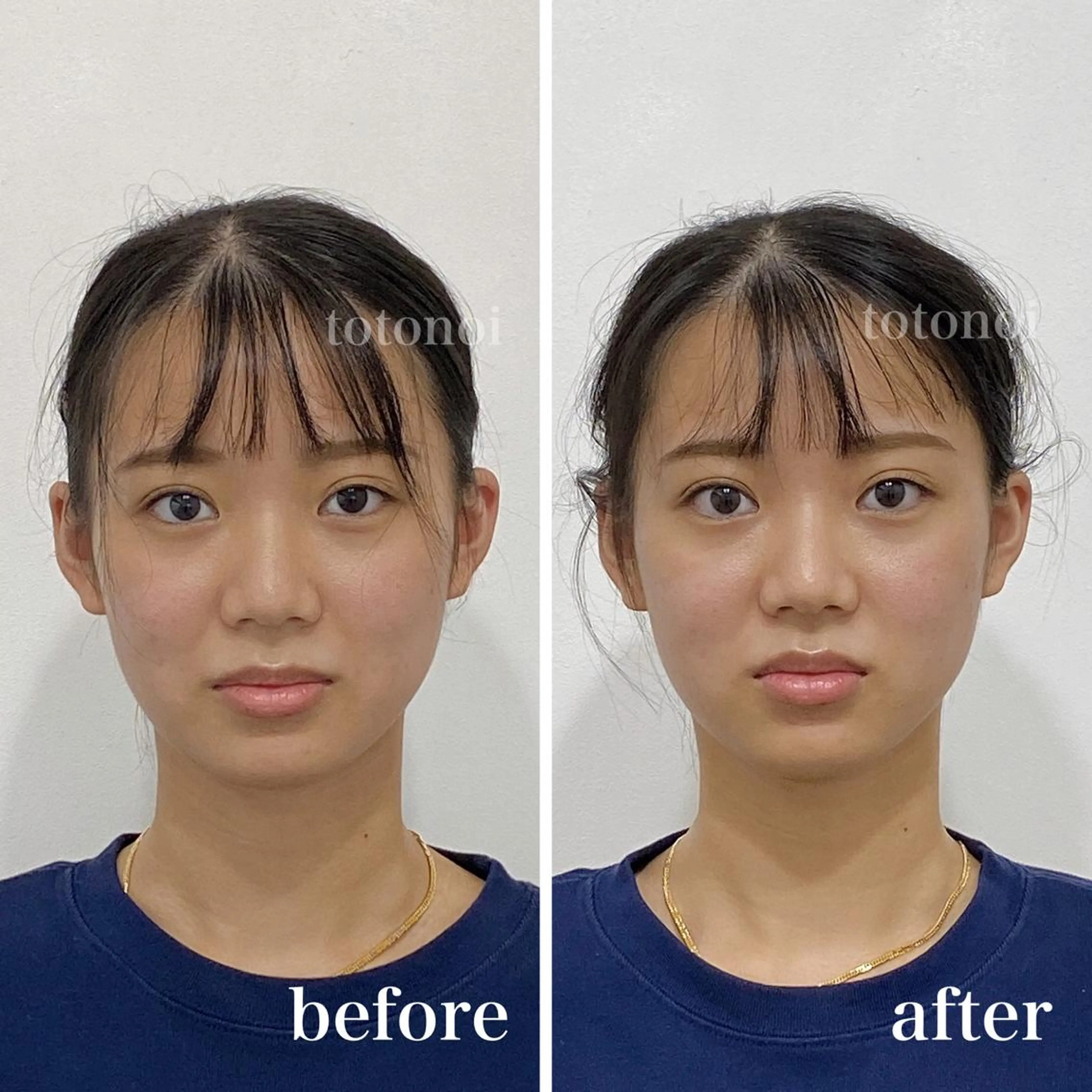 印象の良くなる 美容鍼のエステ・リラクイメージ