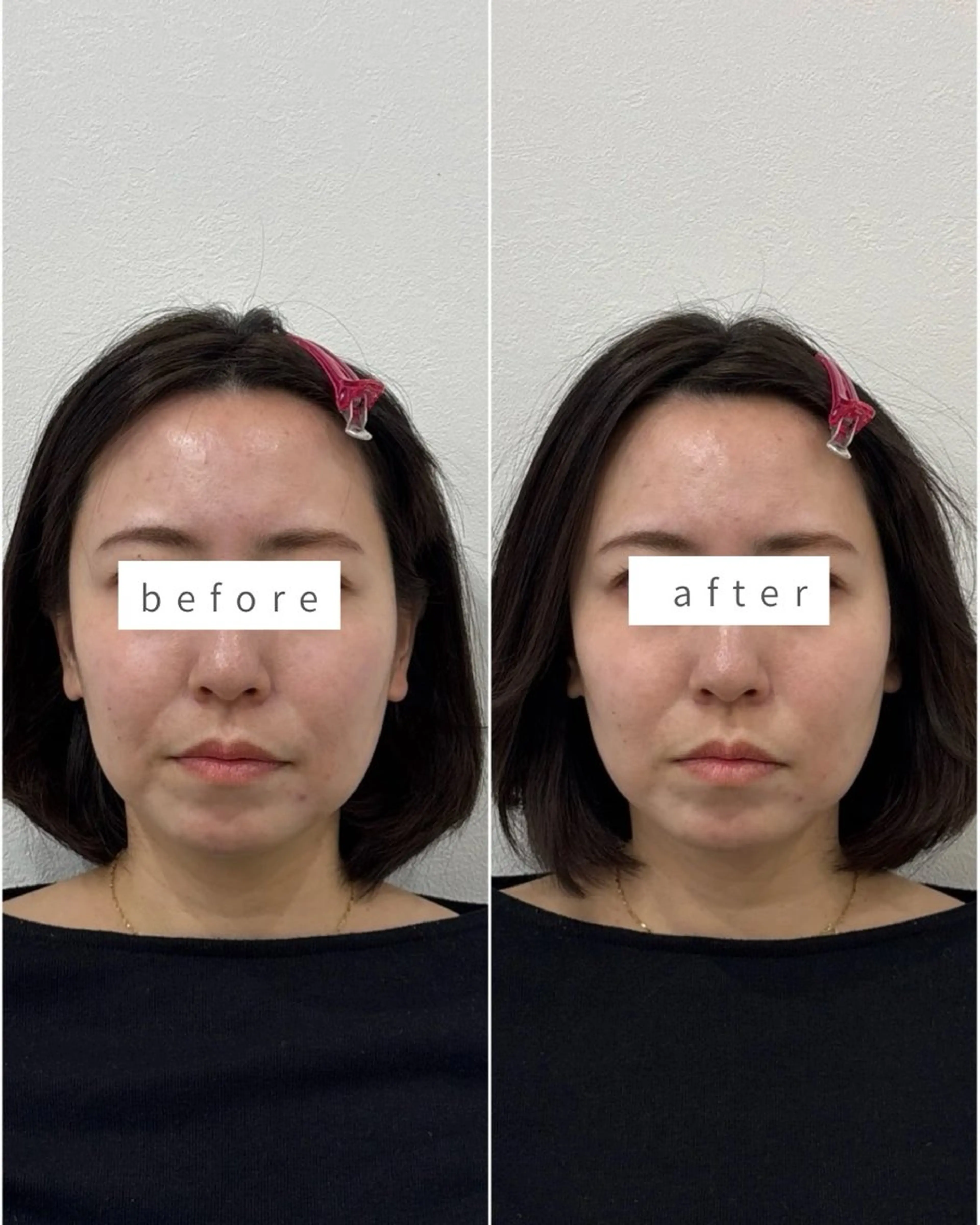 🌿モニター募集🌿20名限定💆🏻‍♀️【たるみを速攻リフトアップ✨むくみ、左右差改善】小顔矯正（カウンセリング込）の写真