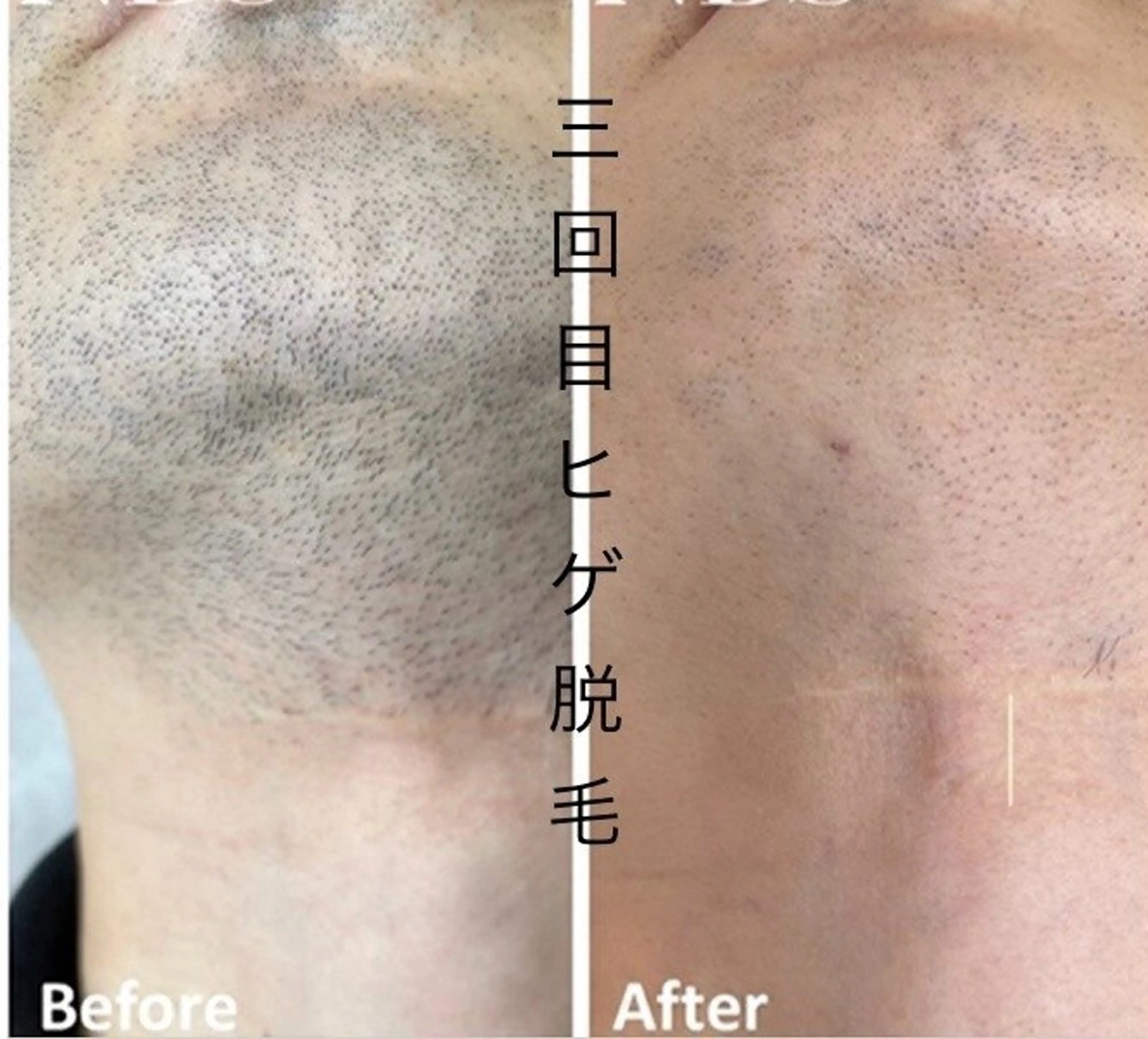 メンズ キッズ 肌管理脱毛ピーリング CDFAkasakaのエステ・リラクイメージ