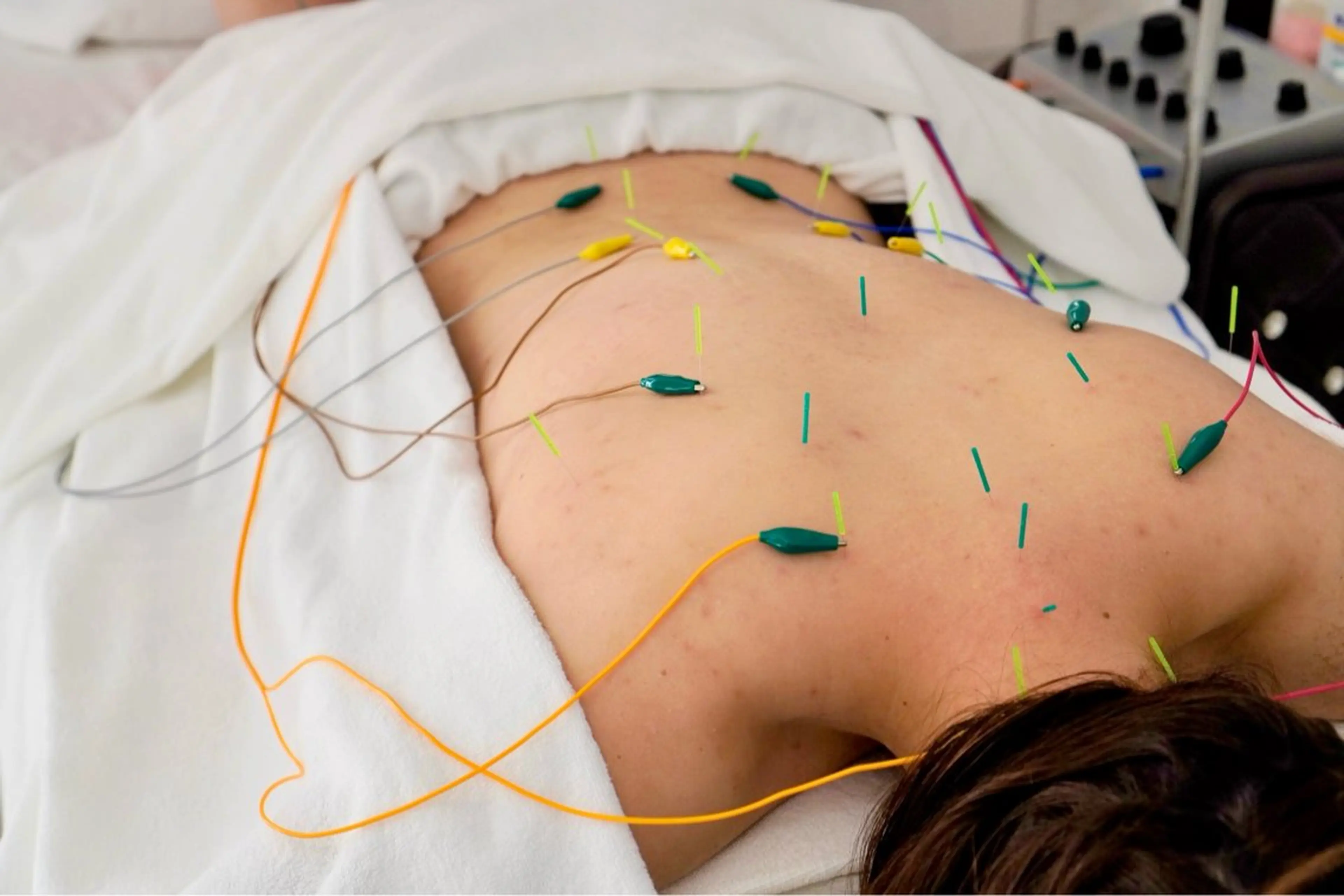 【顔+身体】美容鍼DOLCEコースの写真