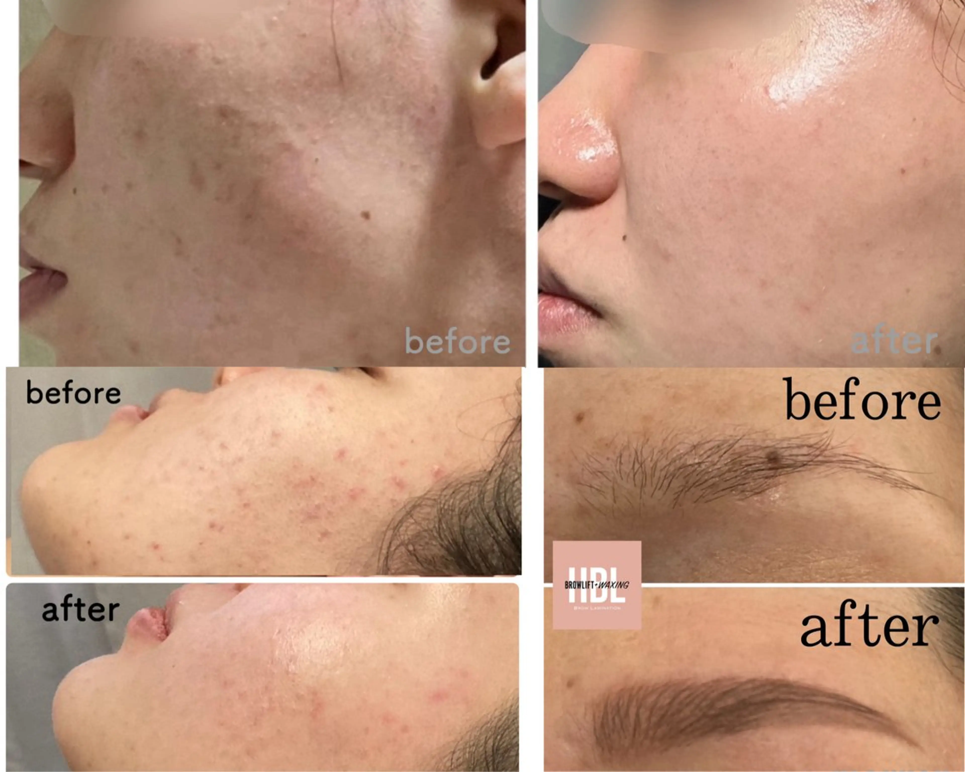 エステ 痩身ハイパーナイフ ララピールリアボーテのエステ・リラクイメージ