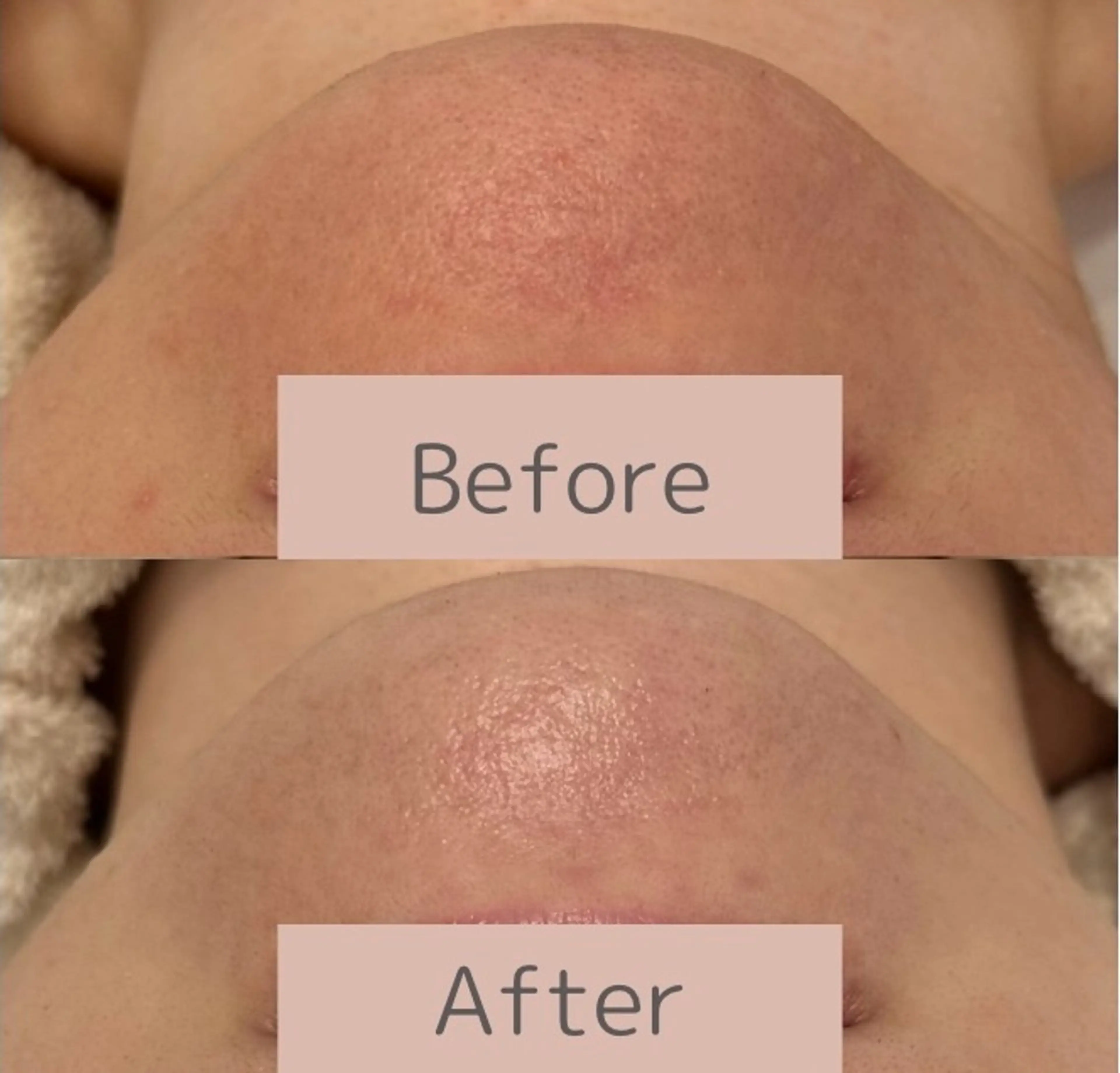 小顔/毛穴/ニキビ salon bealのエステ・リラクイメージ