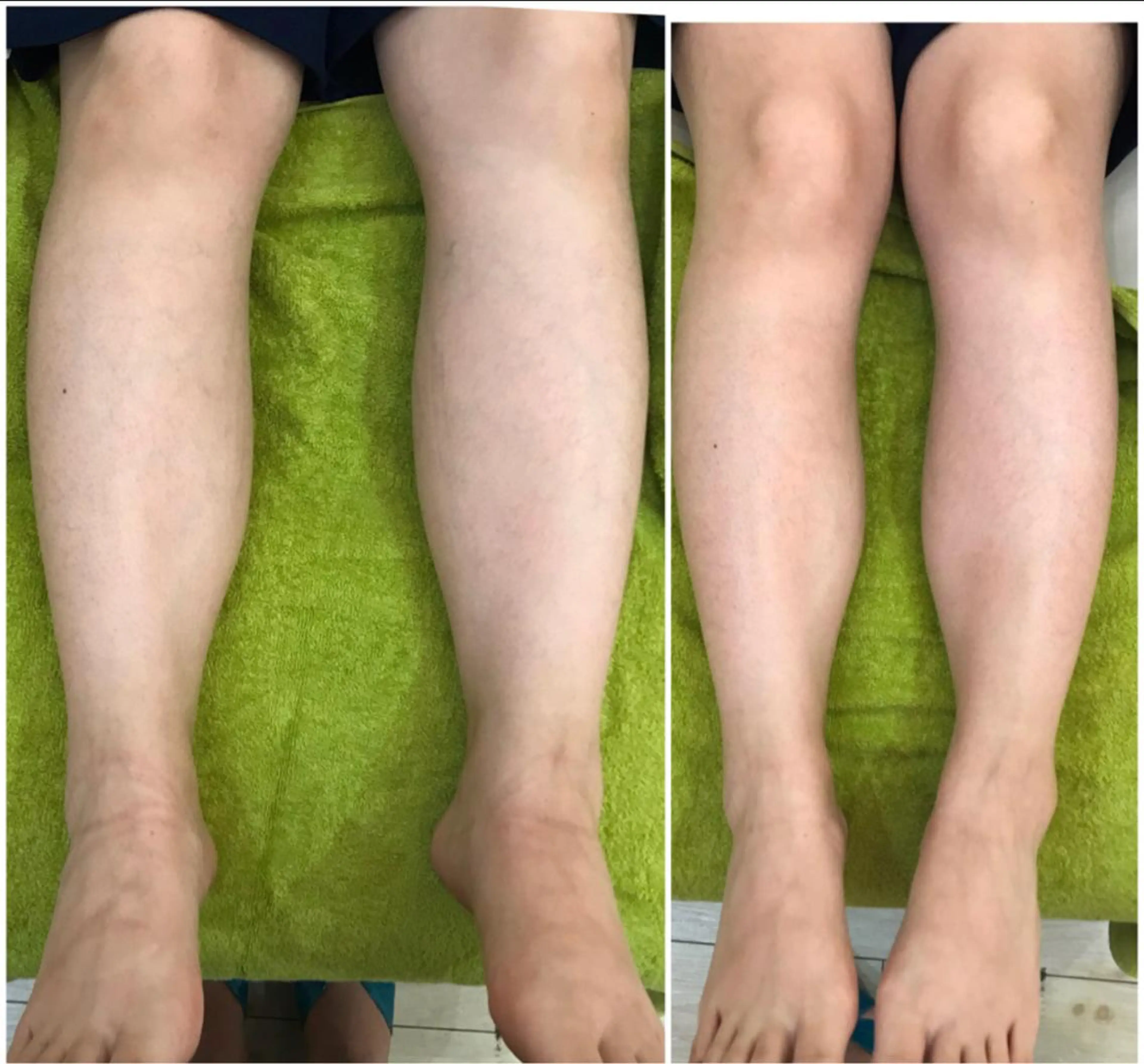 ［美脚・浮腫み解消］重く疲れたふくらはぎの硬く疲れた足のリンパを流すの写真