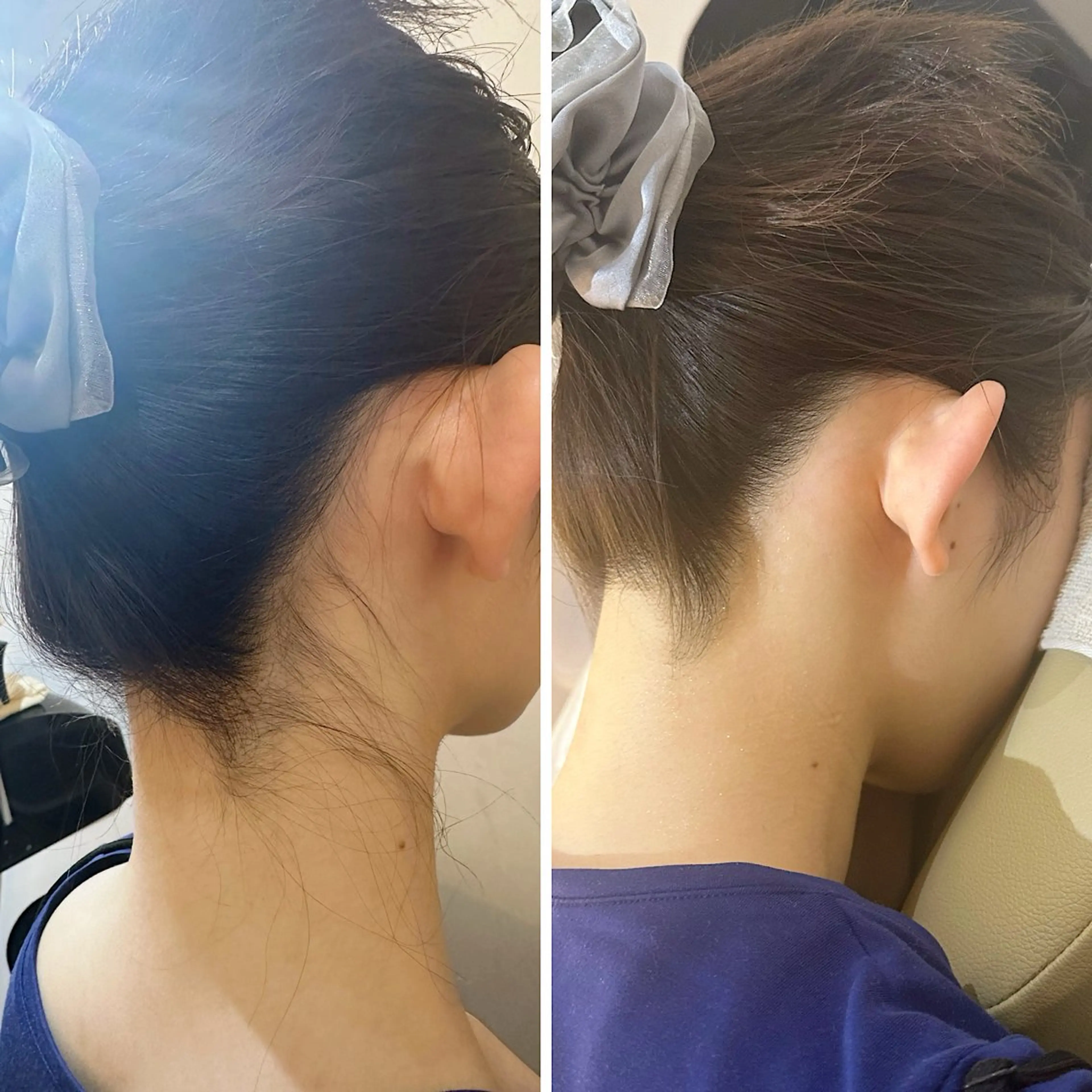 脱毛 うなじ脱毛/美肌脱毛 LABELのエステ・リラクイメージ