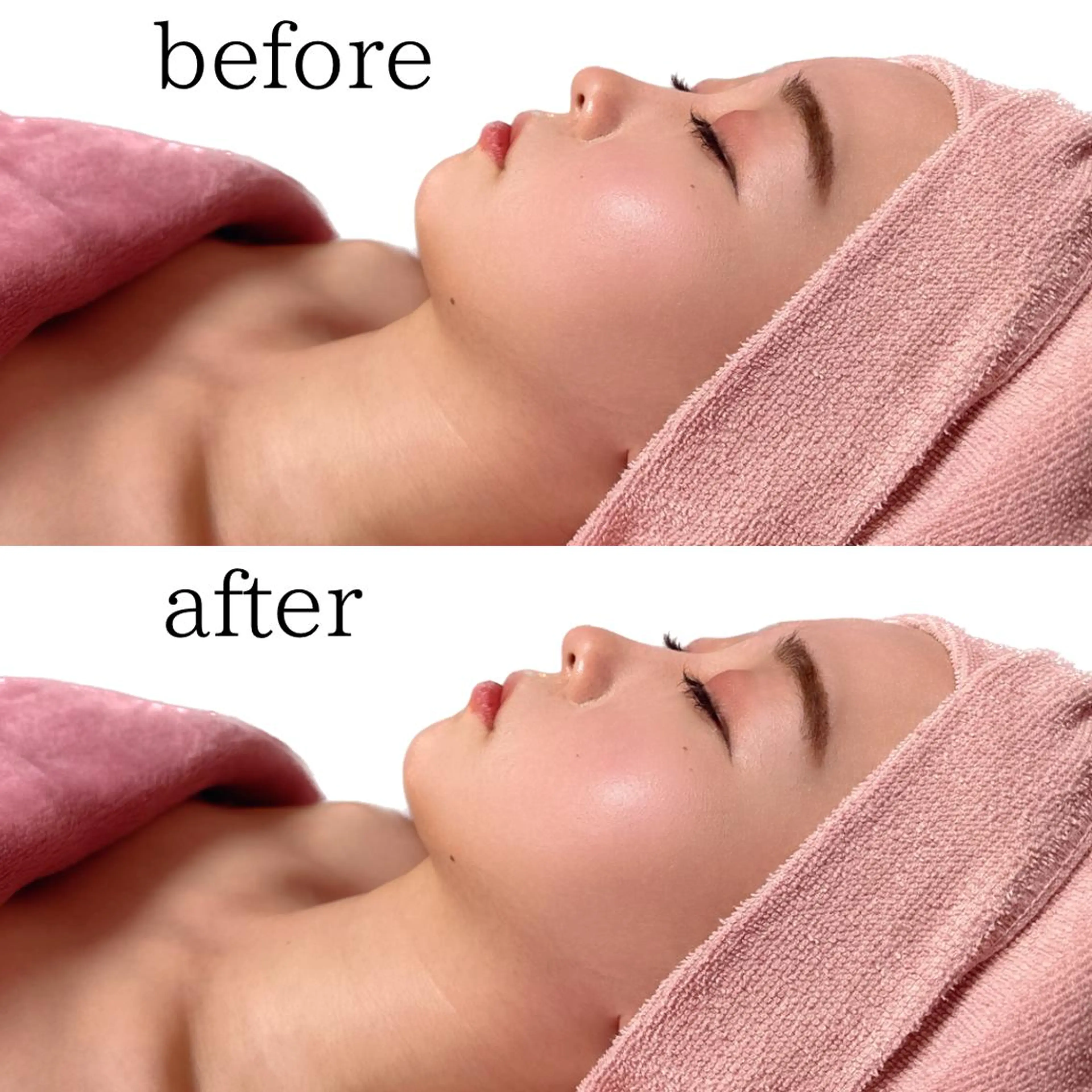 速攻変化😯❣1回で圧倒的小顔効果💖刺さない美容針✨スポット超音波＆EMS美顔器で筋肉にアプローチ✨の写真