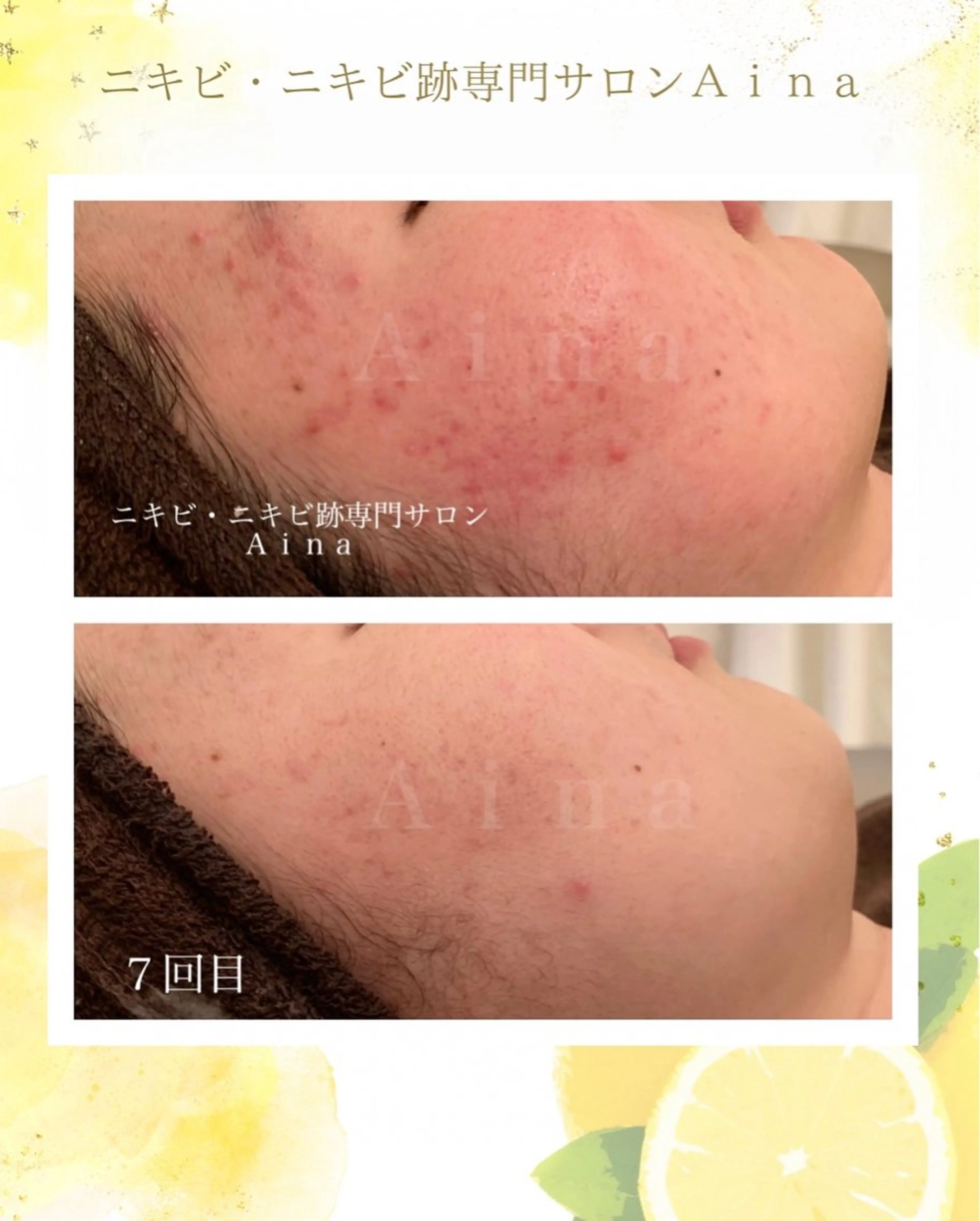 エステ リラク ニキビ跡専門サロン Ａｉｎａのエステ・リラクイメージ