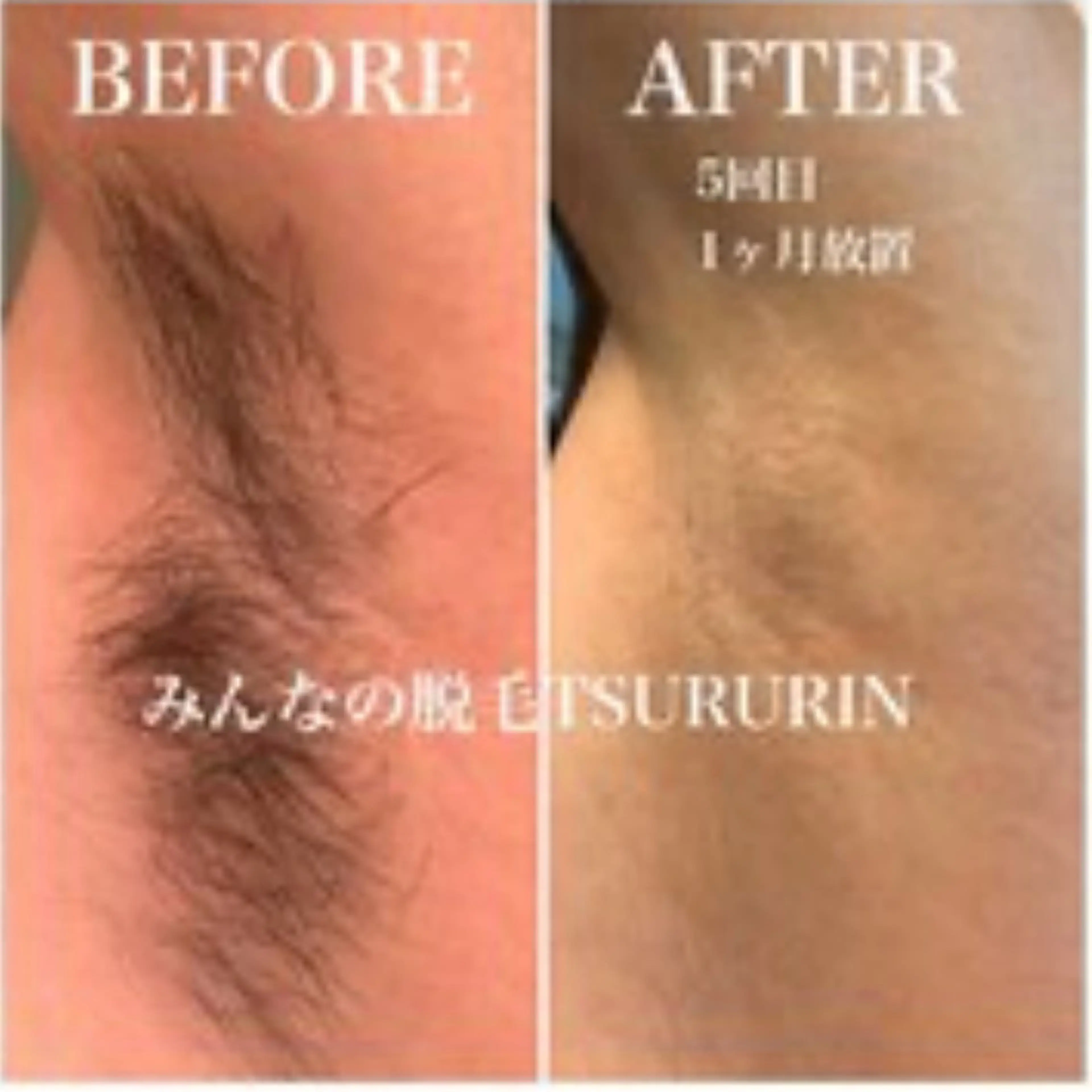 効果を実感✨初回ワキ無料体験☺️✨体験後別メニューで初回予約も可能っ🍀✨（例:全身、ひげセット、など)メンズもOK！の写真