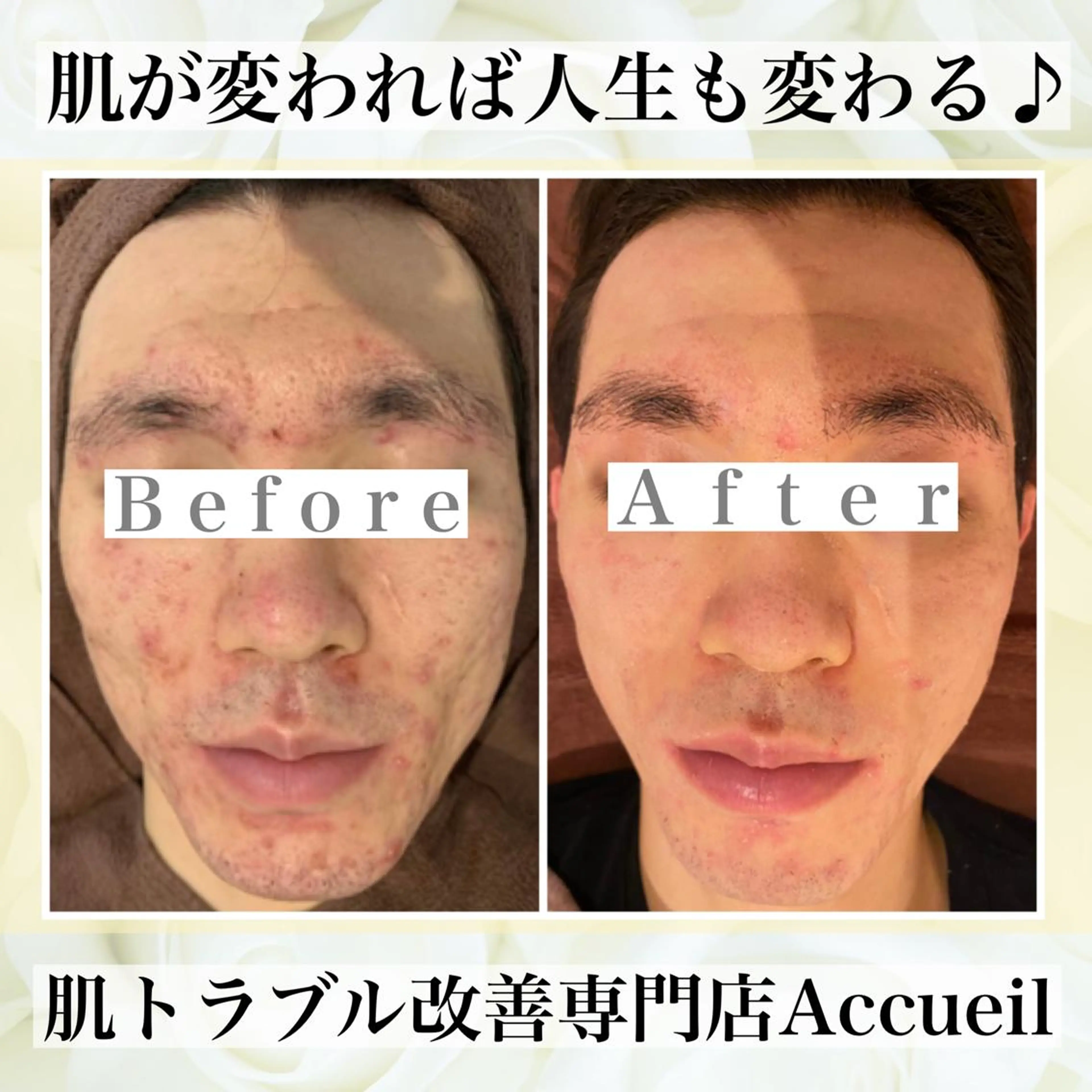 3か月で肌革命👼 ニキビ専門店💫のエステ・リラクイメージ