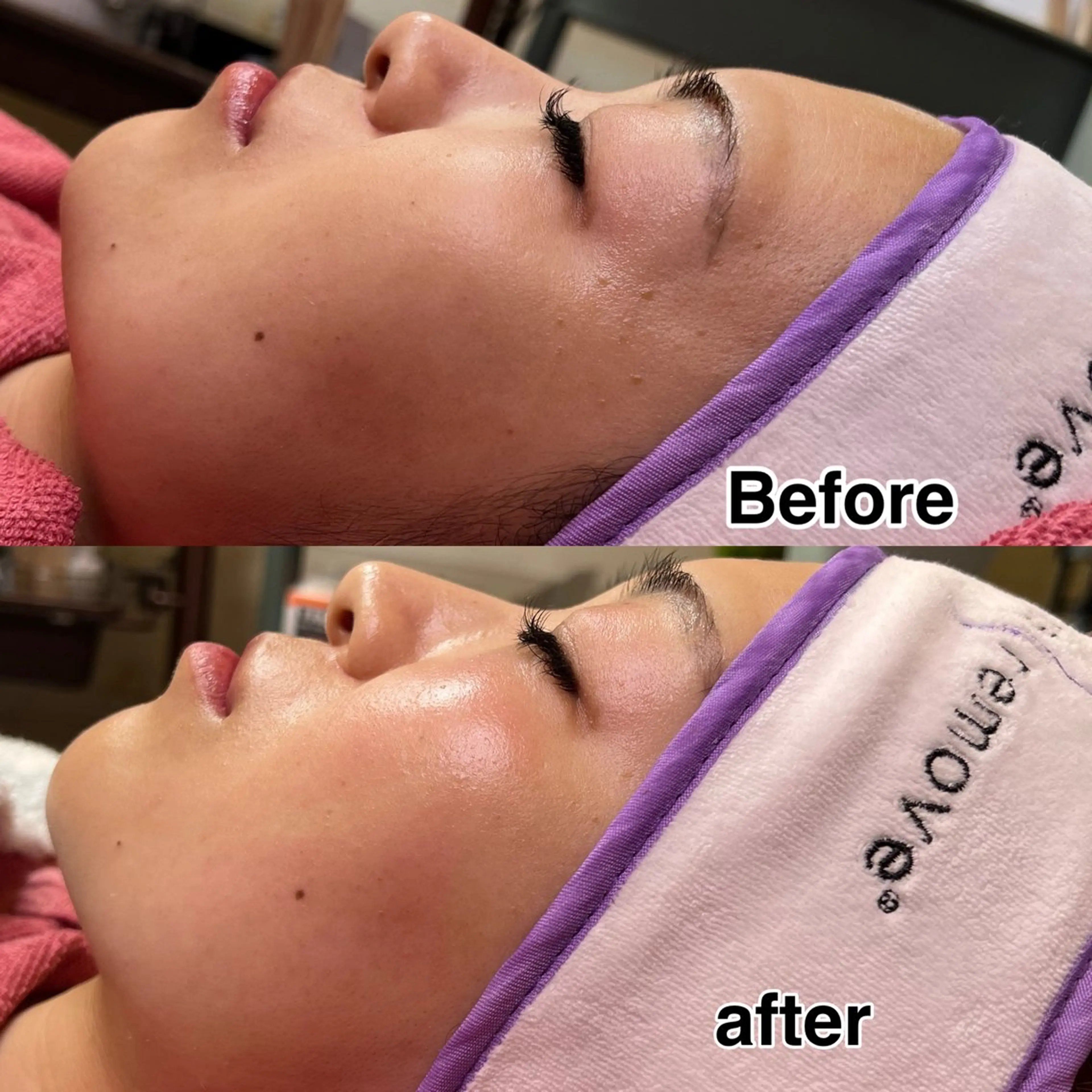 【マリムーブフェイシャルワックス認定サロン】安心安全なマリムーブワックスで、お顔の産毛脱毛メニュー9900円→7980円の写真