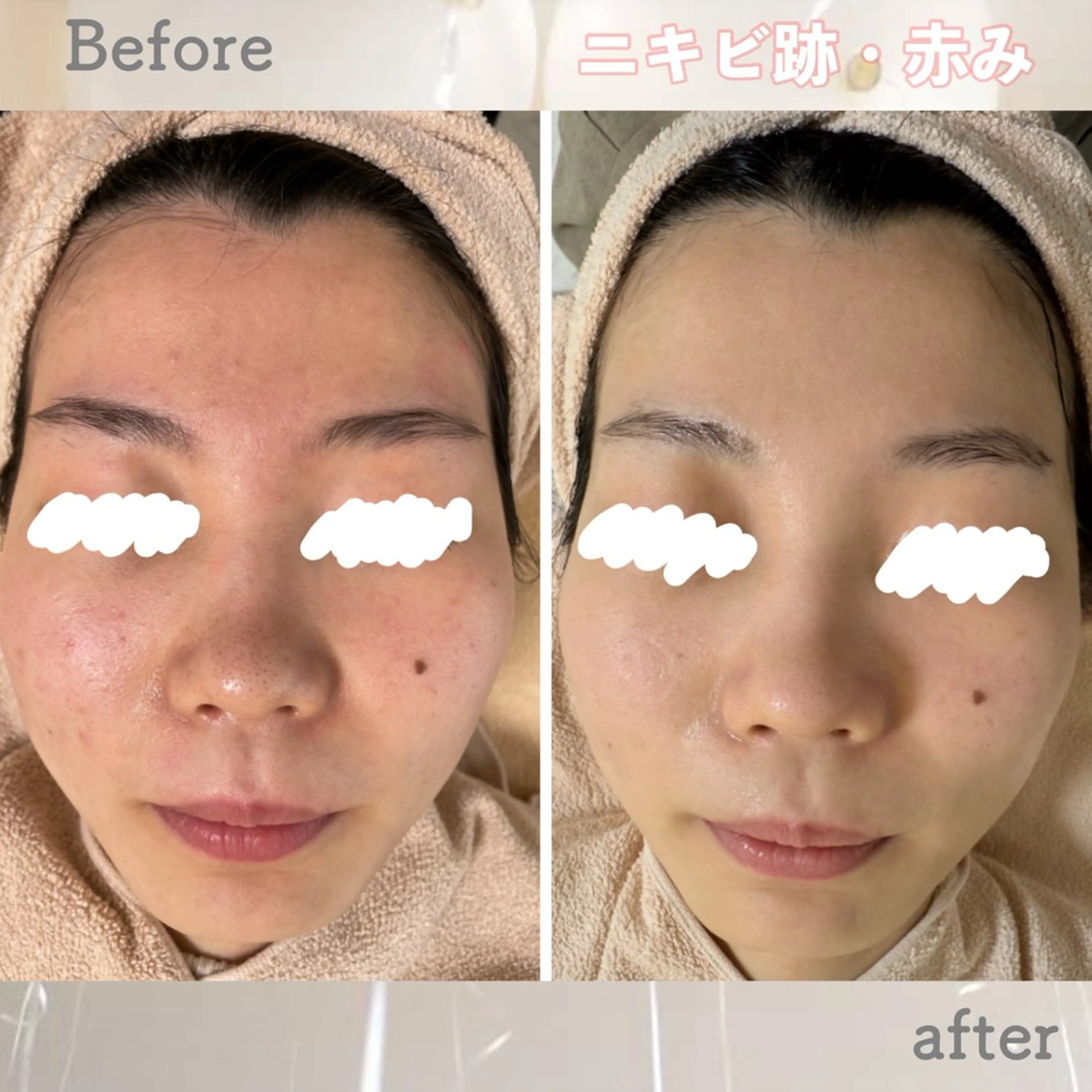 エステ ニキビ&跡改善サロン オーナー光木のエステ・リラクイメージ