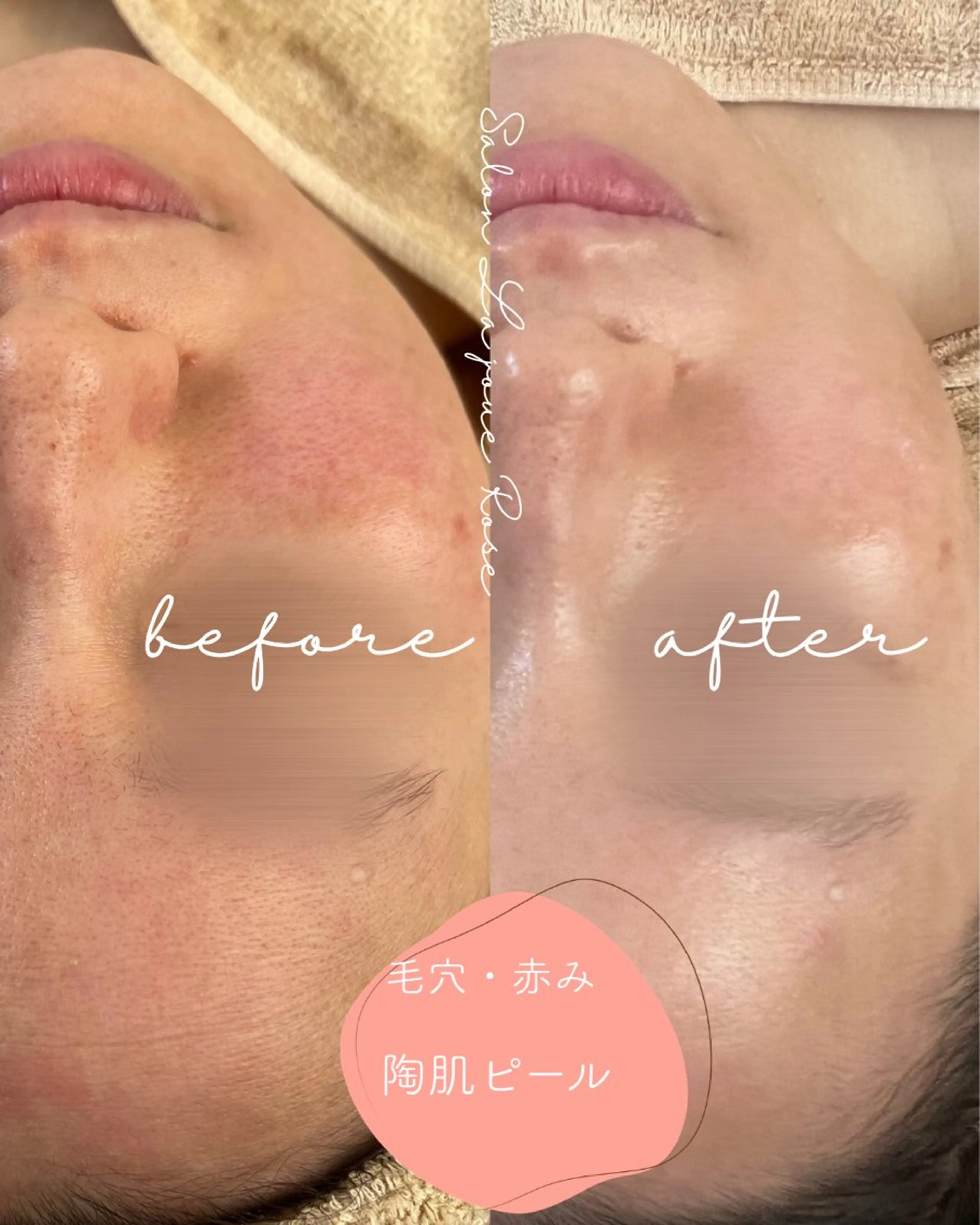 【初回】人気ＮＯ.1 陶肌♡ナノバブルピール(毛穴・くすみ・白ニキビ)の写真
