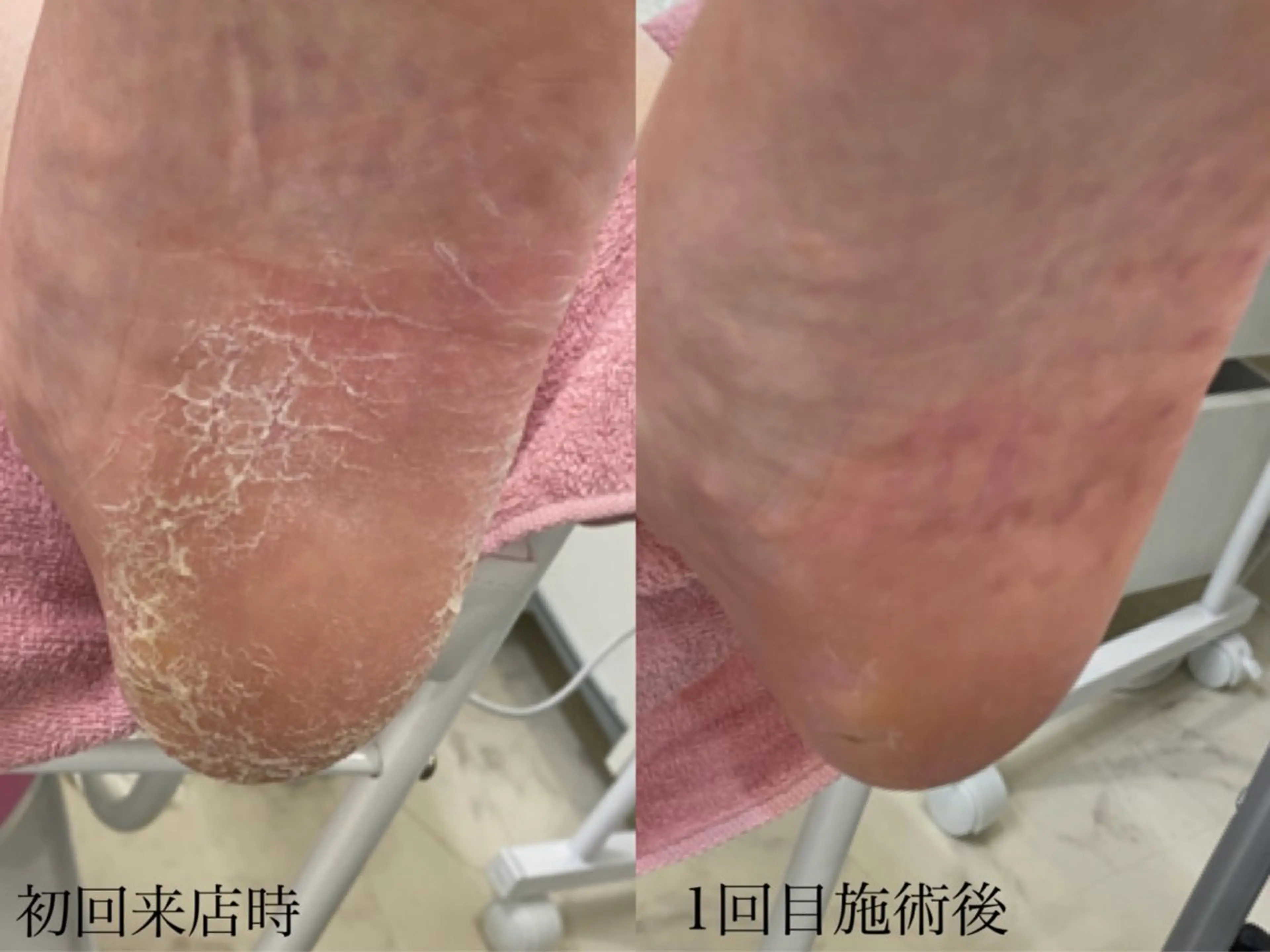 本格足裏角質ケアの写真