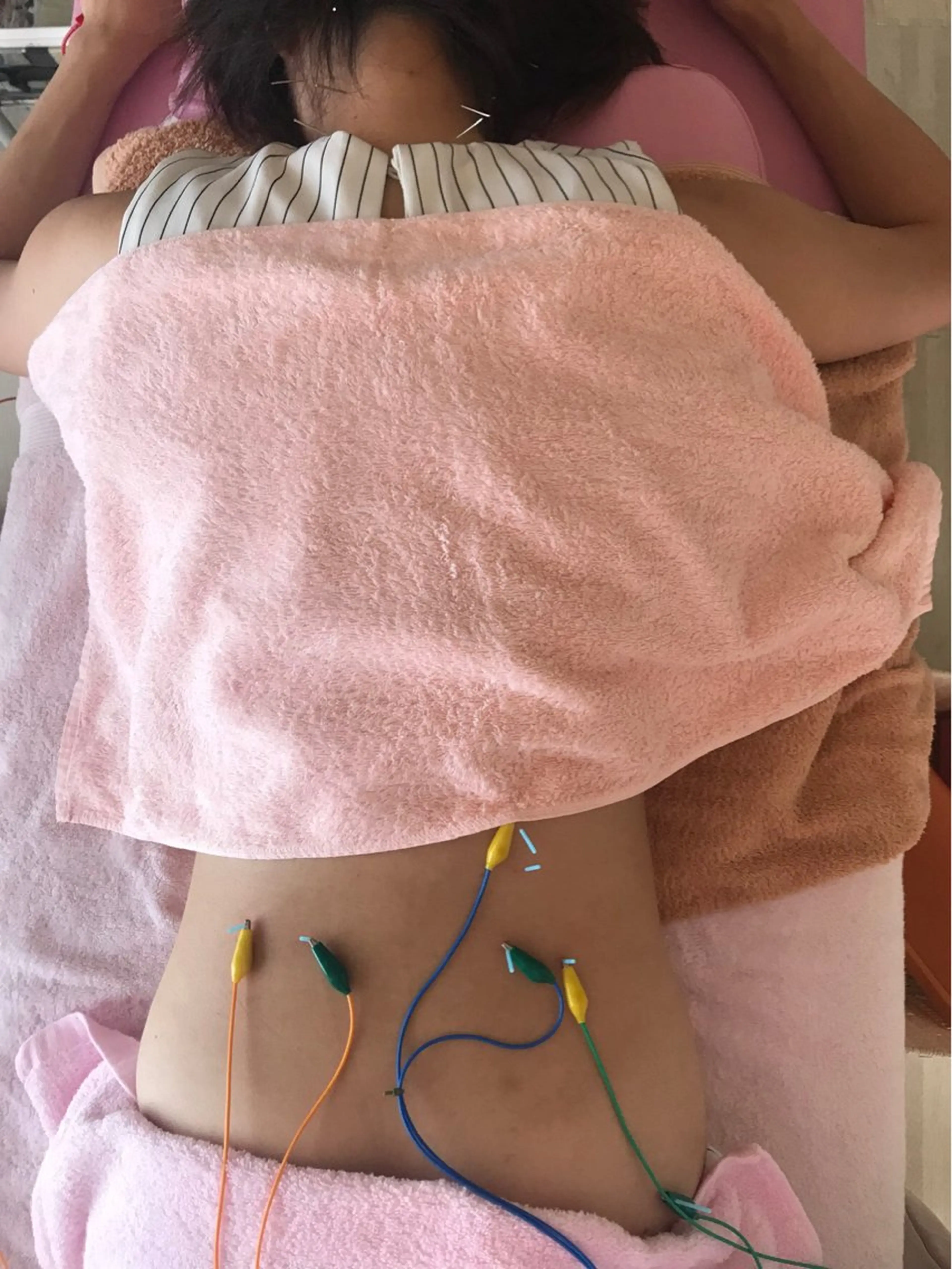 🌈ミニモ限定メニュー🌈【腰・足】部分鍼灸コース🕰️30分4,950円↓❣️腰・足に対して集中的に施術🔥の写真