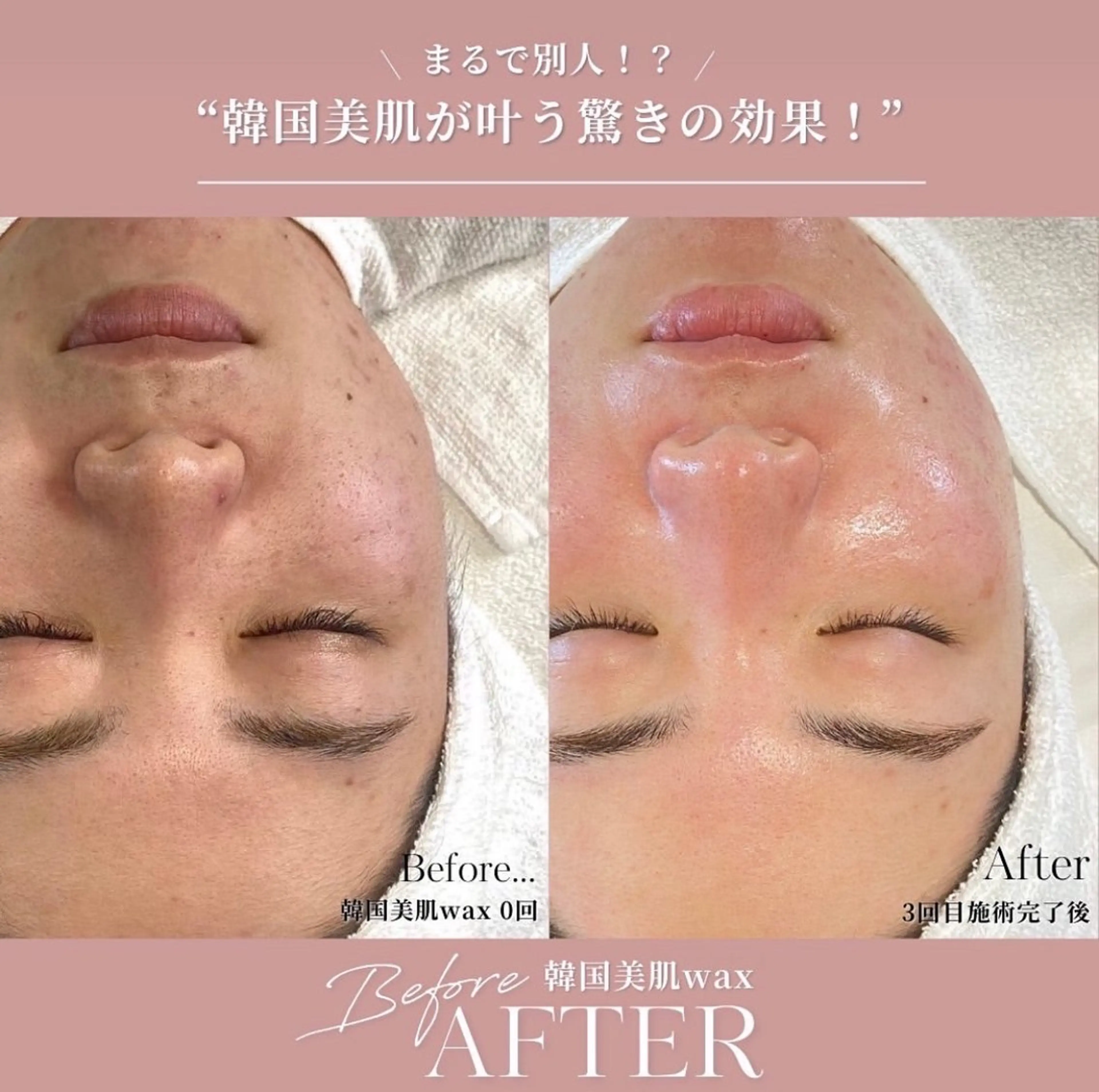 イベント前に顔脱毛💁‍♀️艶肌WAX🫧従来のフェイスWAXとは違い美容成分たっぷり♡つるんとした肌質へ艶爆誕✨の写真