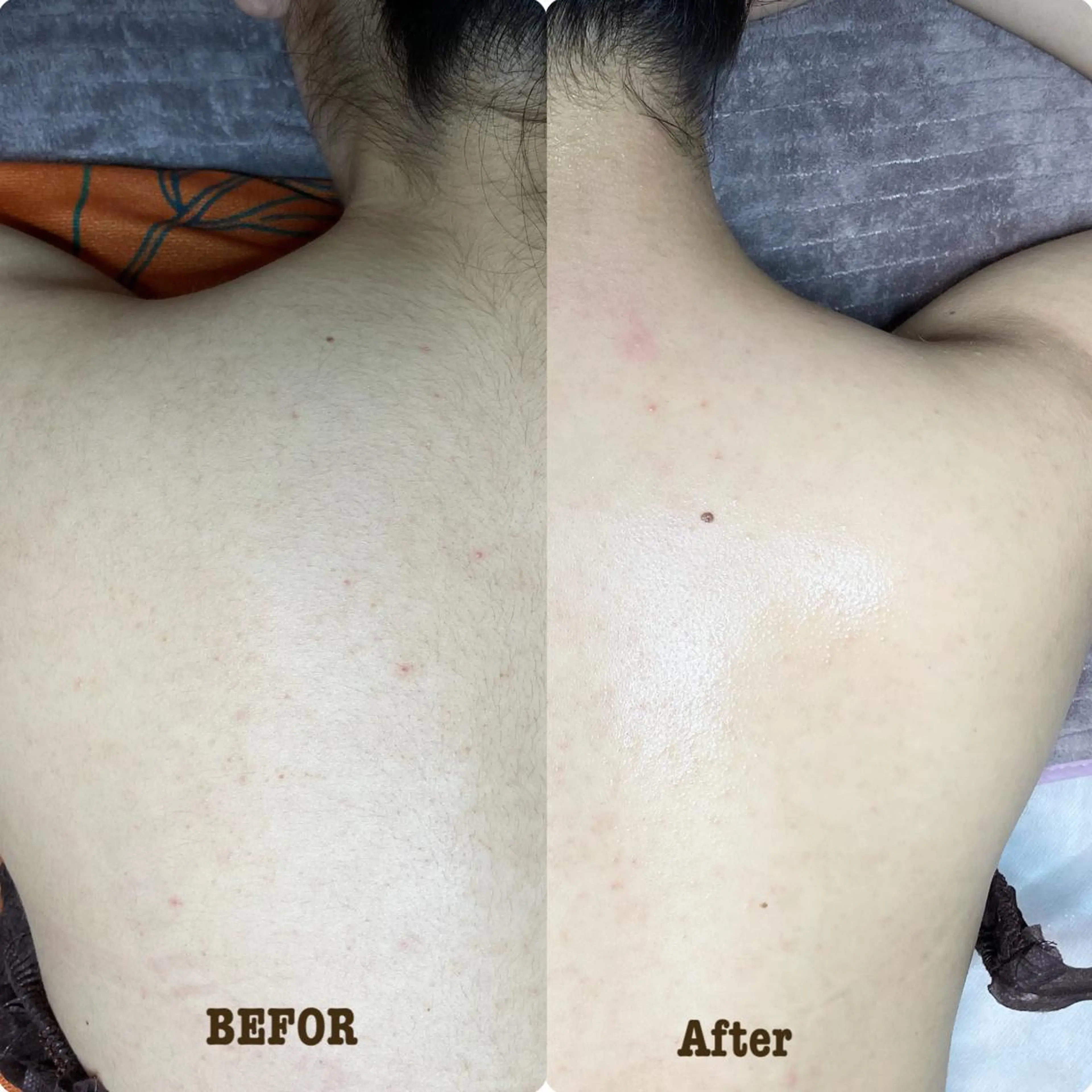 【女性wax】背中FULL＋うなじの写真