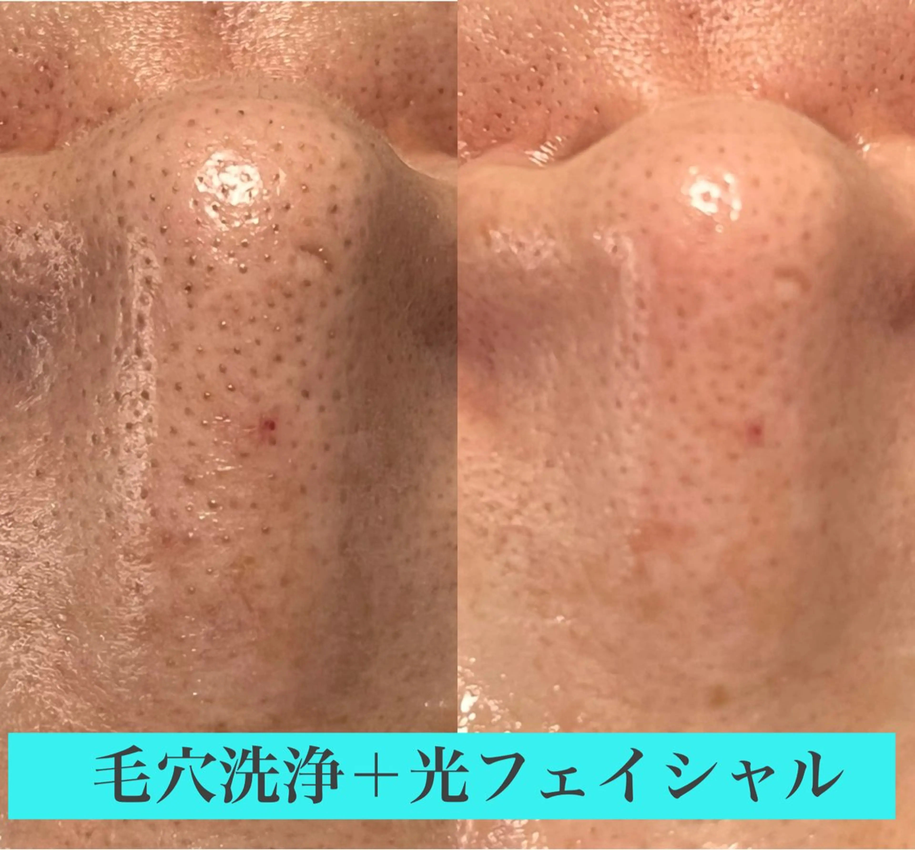 エステ 毛穴洗浄🍀脱毛🍀 光フェイシャル🍀のエステ・リラクイメージ