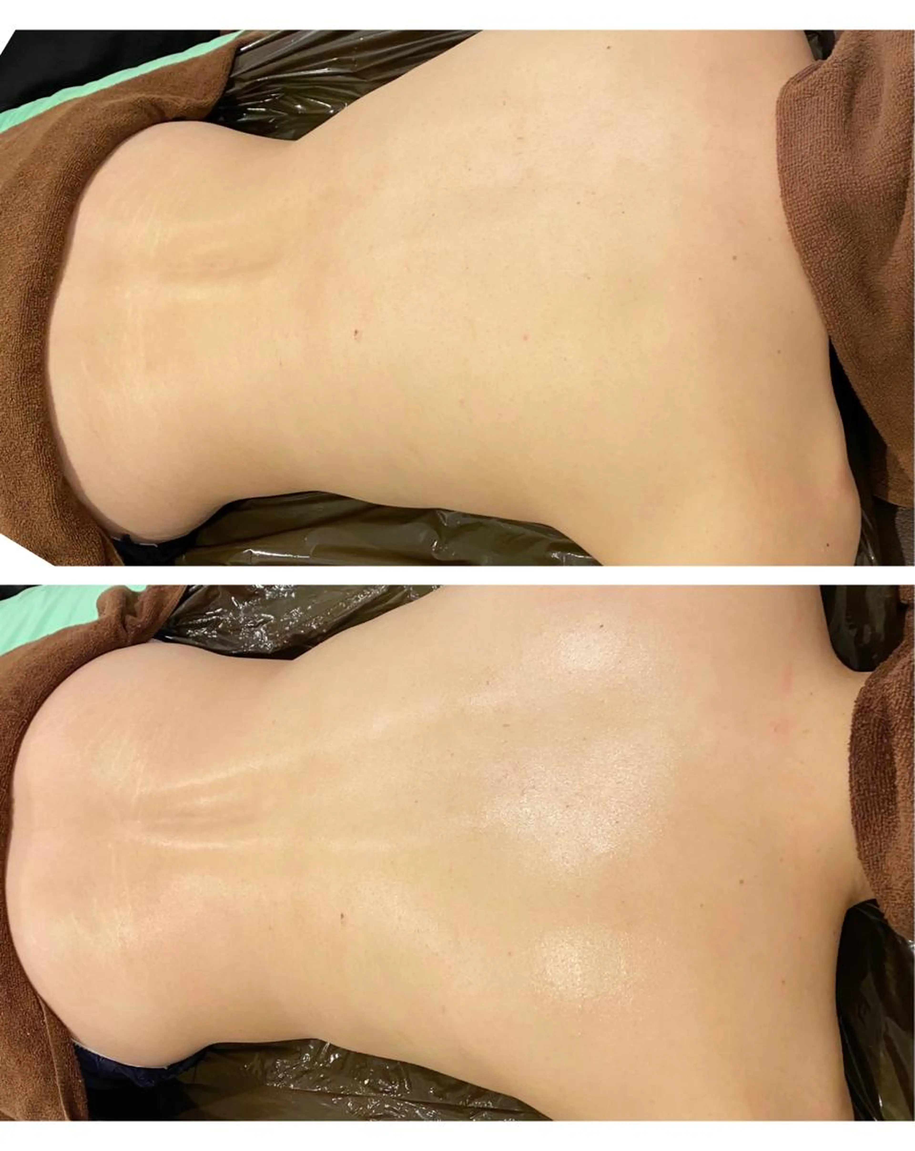 【人気急上昇🔥】圧倒的❣️美背中ケア🫢自分では気がついていないかも？案外人から見られている背中。肌荒れ、ニキビ、シワの写真