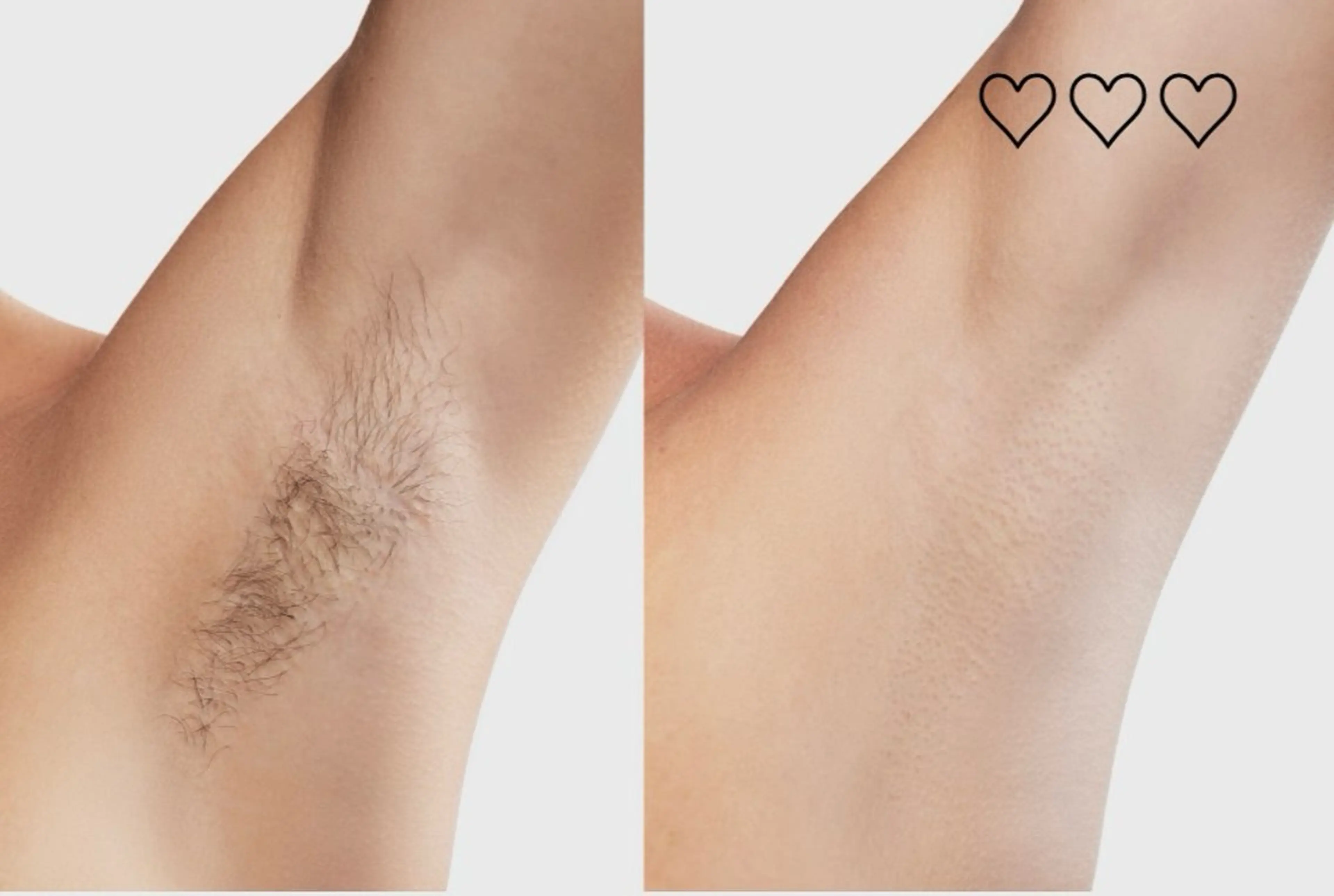 【男性限定】最先端脱毛機械！剛毛脇毛×ふくらはぎ脱毛×腕脱毛　気になる部位3部位まとめてケアの写真