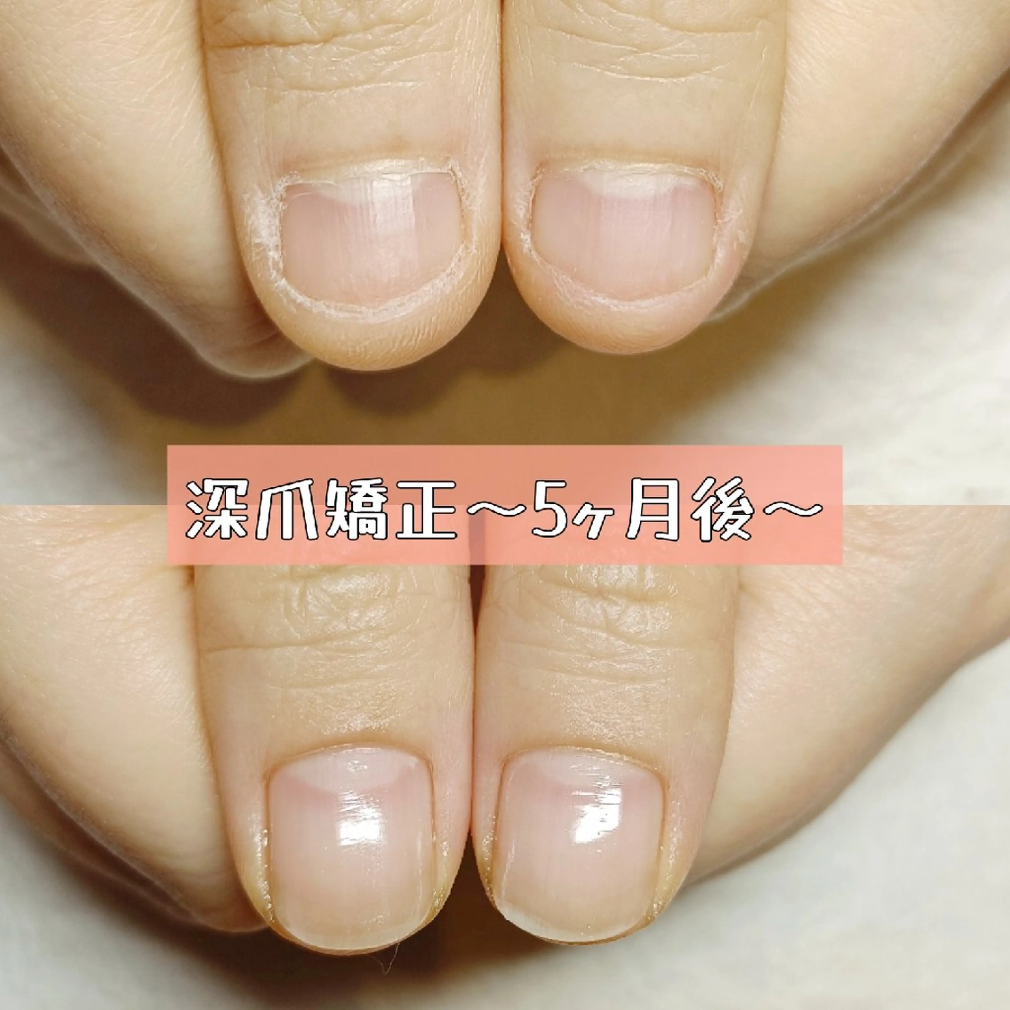 ネイル 長さ出し スカルプネイル ハンドネイル ハンドケア 深爪矯正/爪育成ケア manie nailのネイルデザイン
