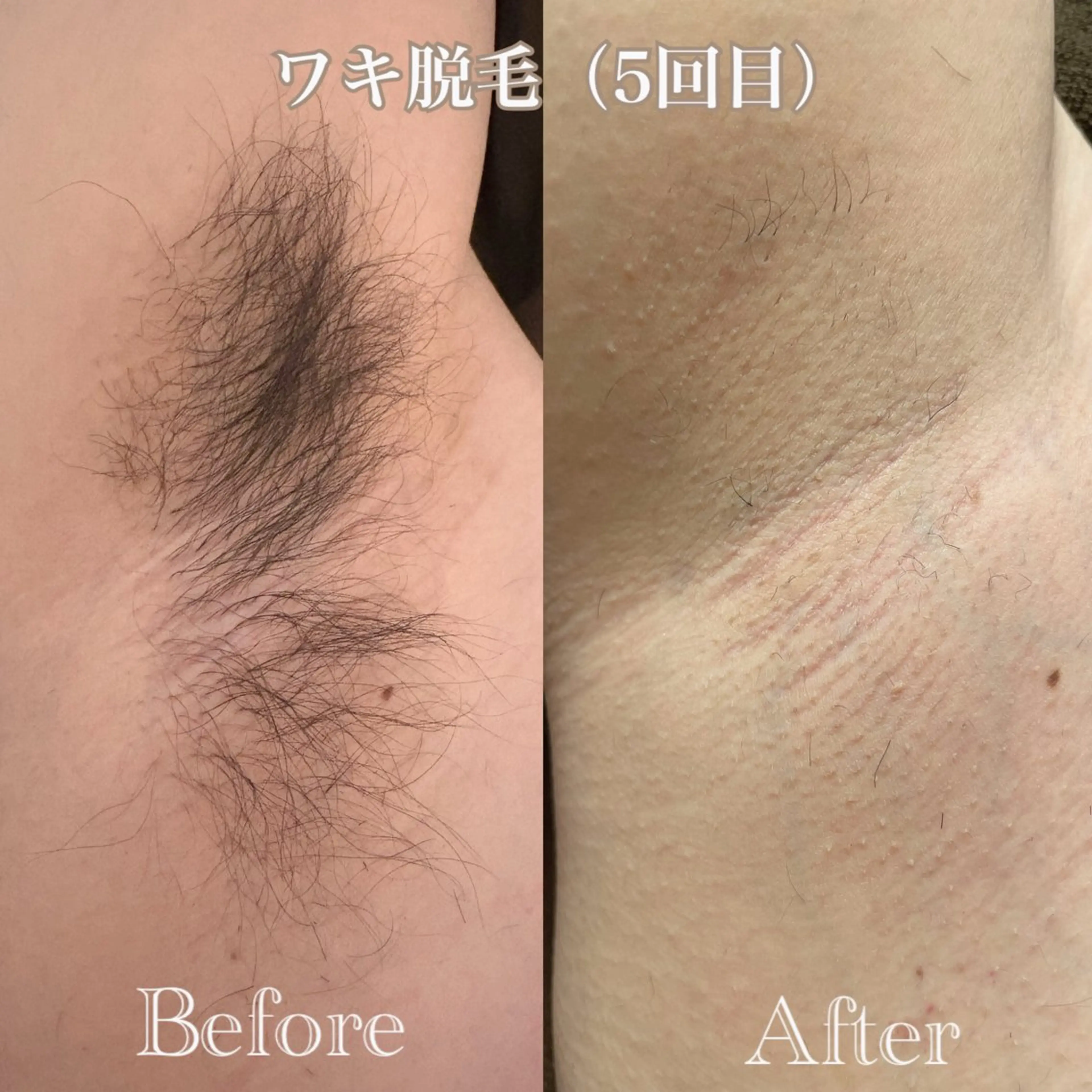 【ワンコイン】ワキ脱毛（レディース・メンズ）¥500の写真