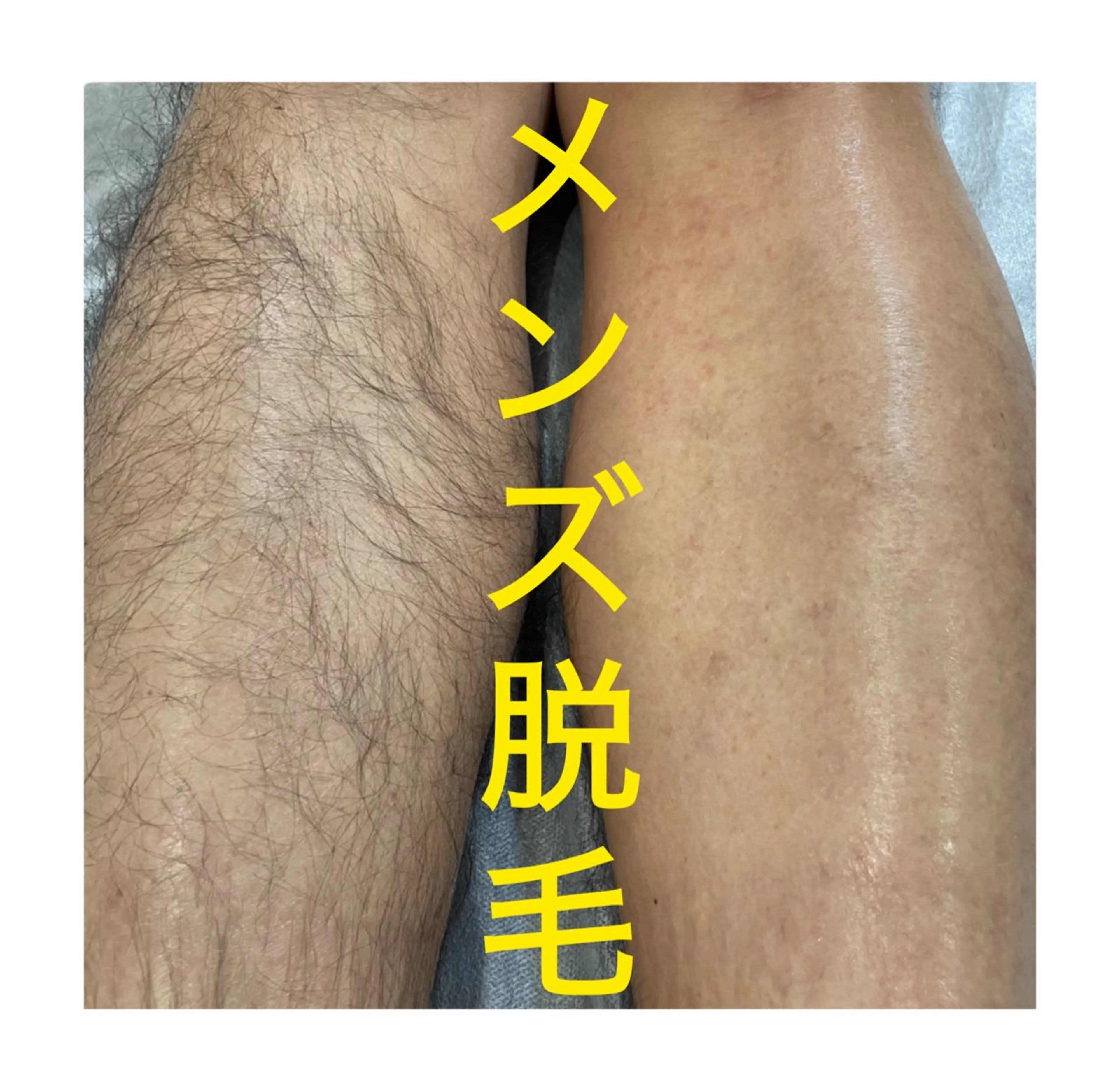 男性全身 NPL方式光脱毛 お試し価格(全身•髭•VIO込み)の写真