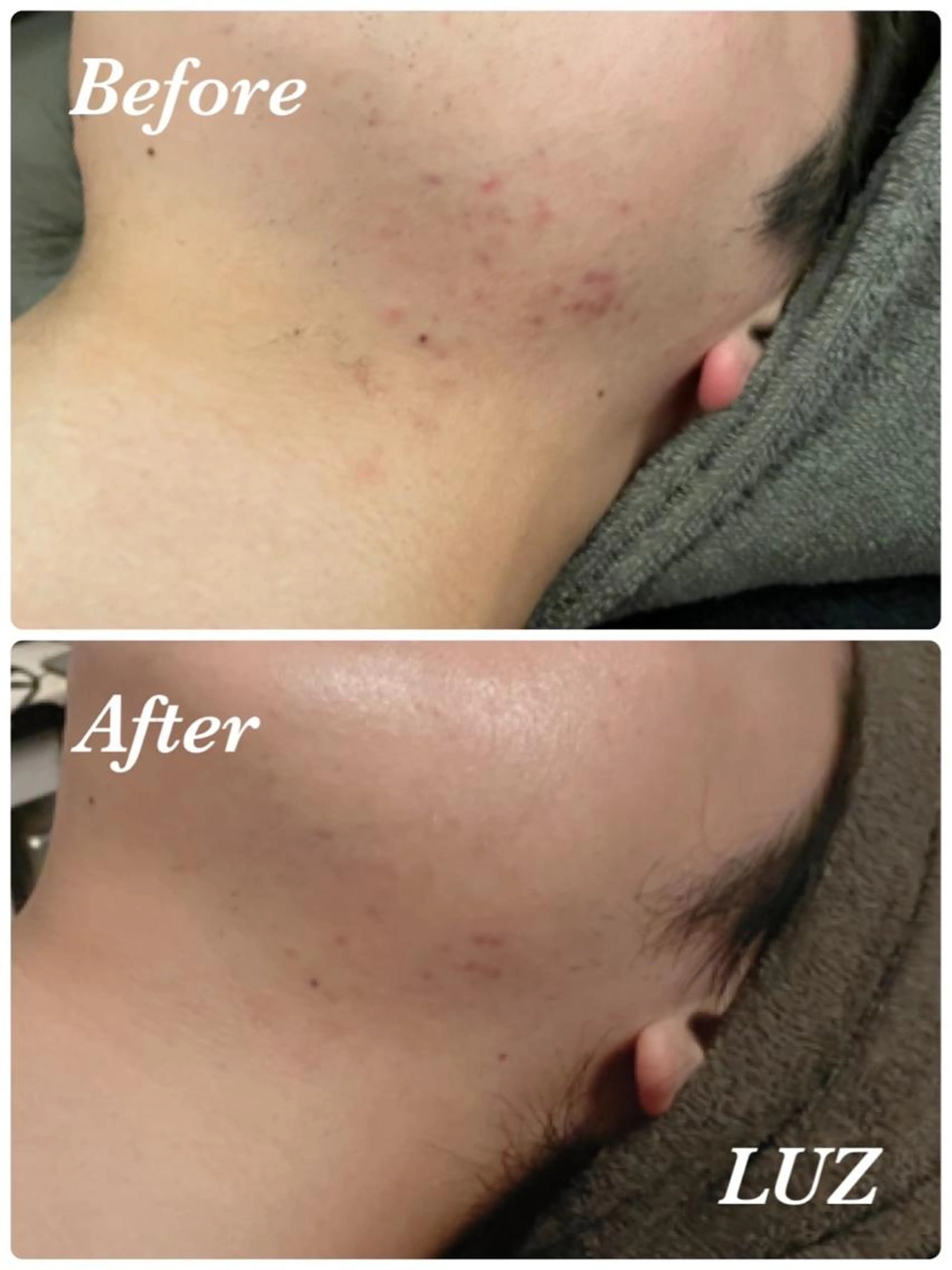 メンズニキビ・肌荒れ・肌トラブル👉 回復エステ 充実の8工程 蕨・南浦和駅送迎/男性施術者/完全個室/駐車場完備/の写真