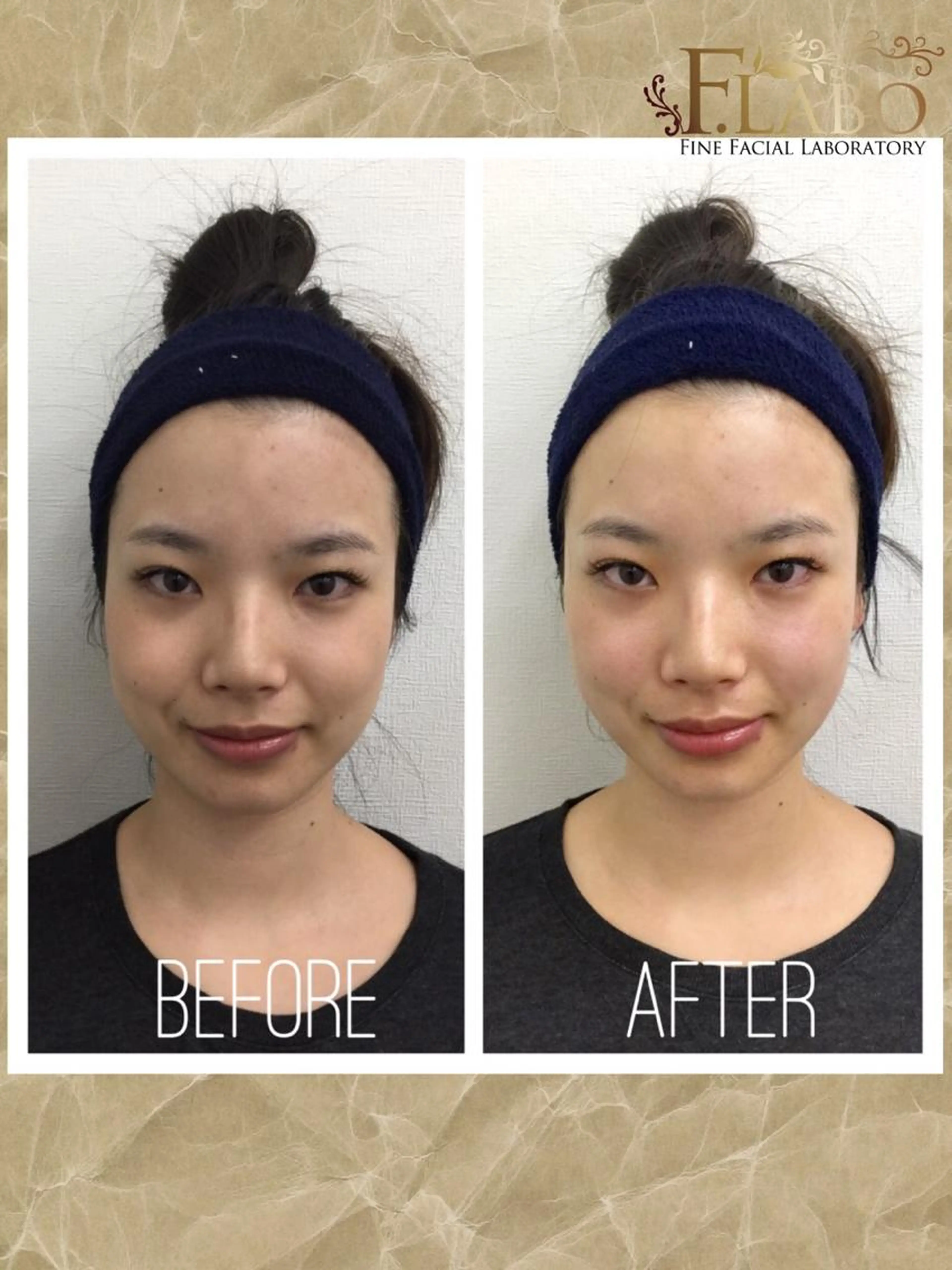 【9時​〜​15時限定】ラジオ波フェイシャルトリートメント ▶︎minimo限定✨お悩みに合わせたハイブリッドパック付きの写真