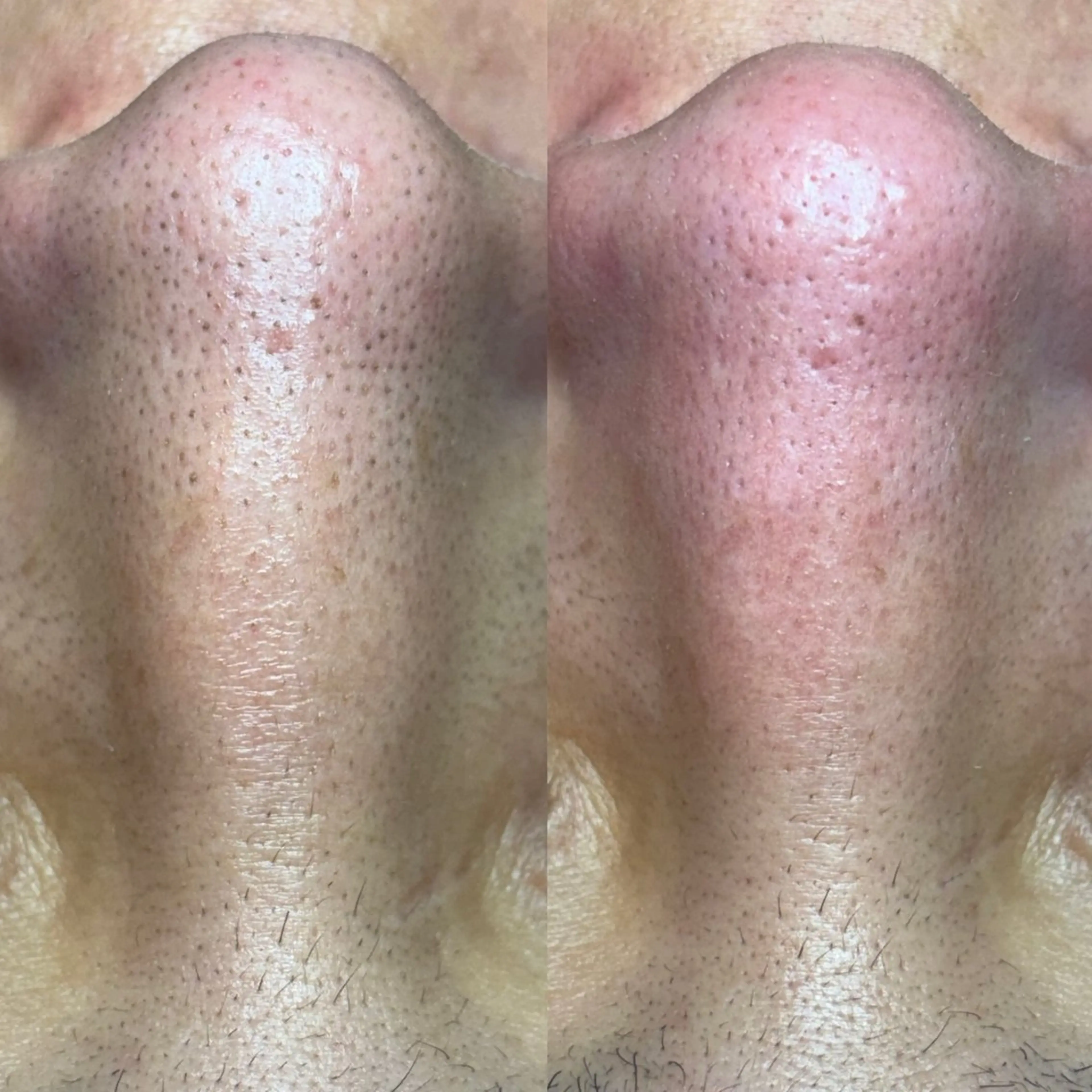 🌱ミニモ限定。毛穴エクストラクション2回目以降の写真