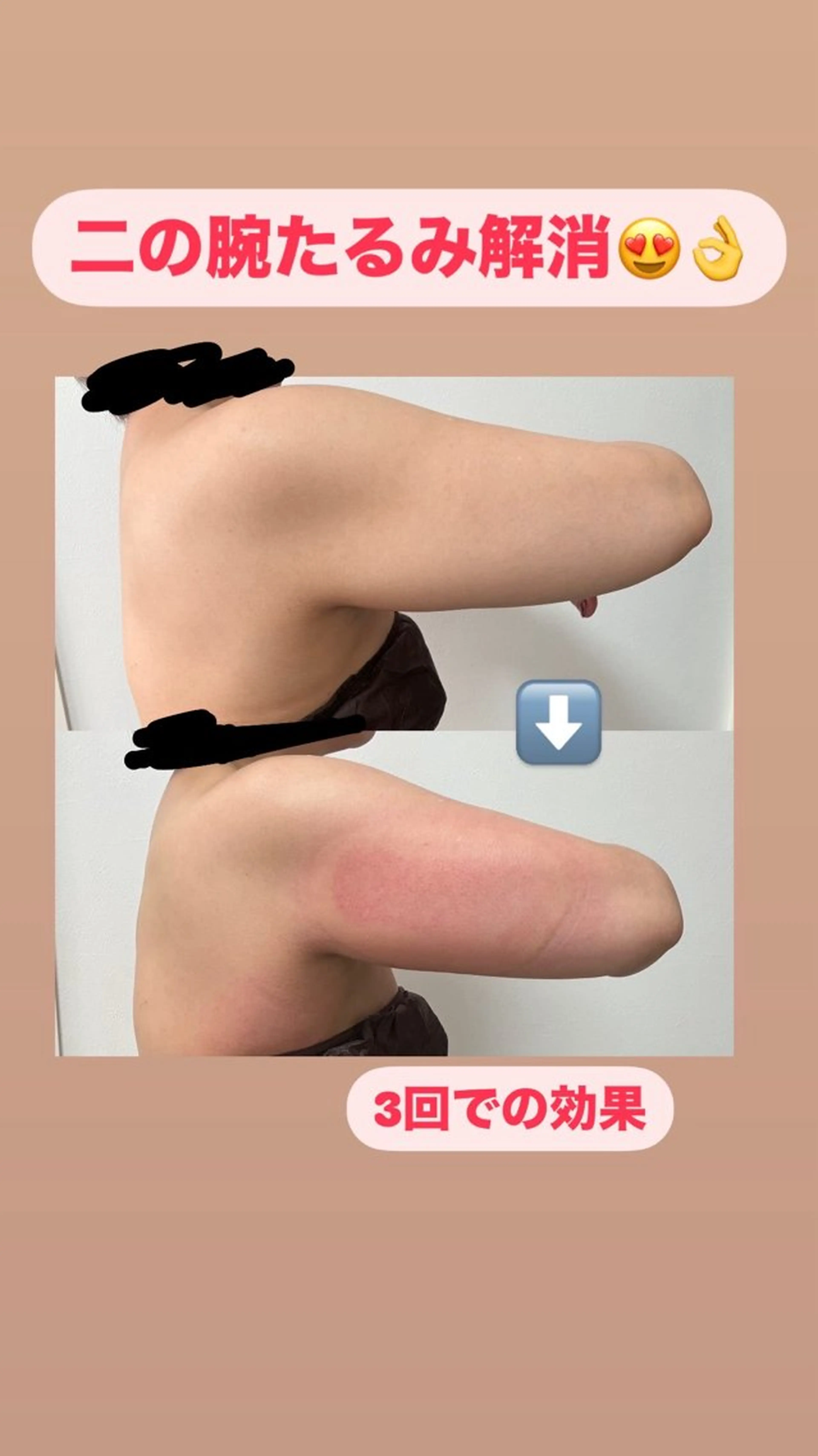 初回 お好きな箇所2カップ(下っ腹、内もも、二の腕、ふくらはぎにおすすめ)の写真