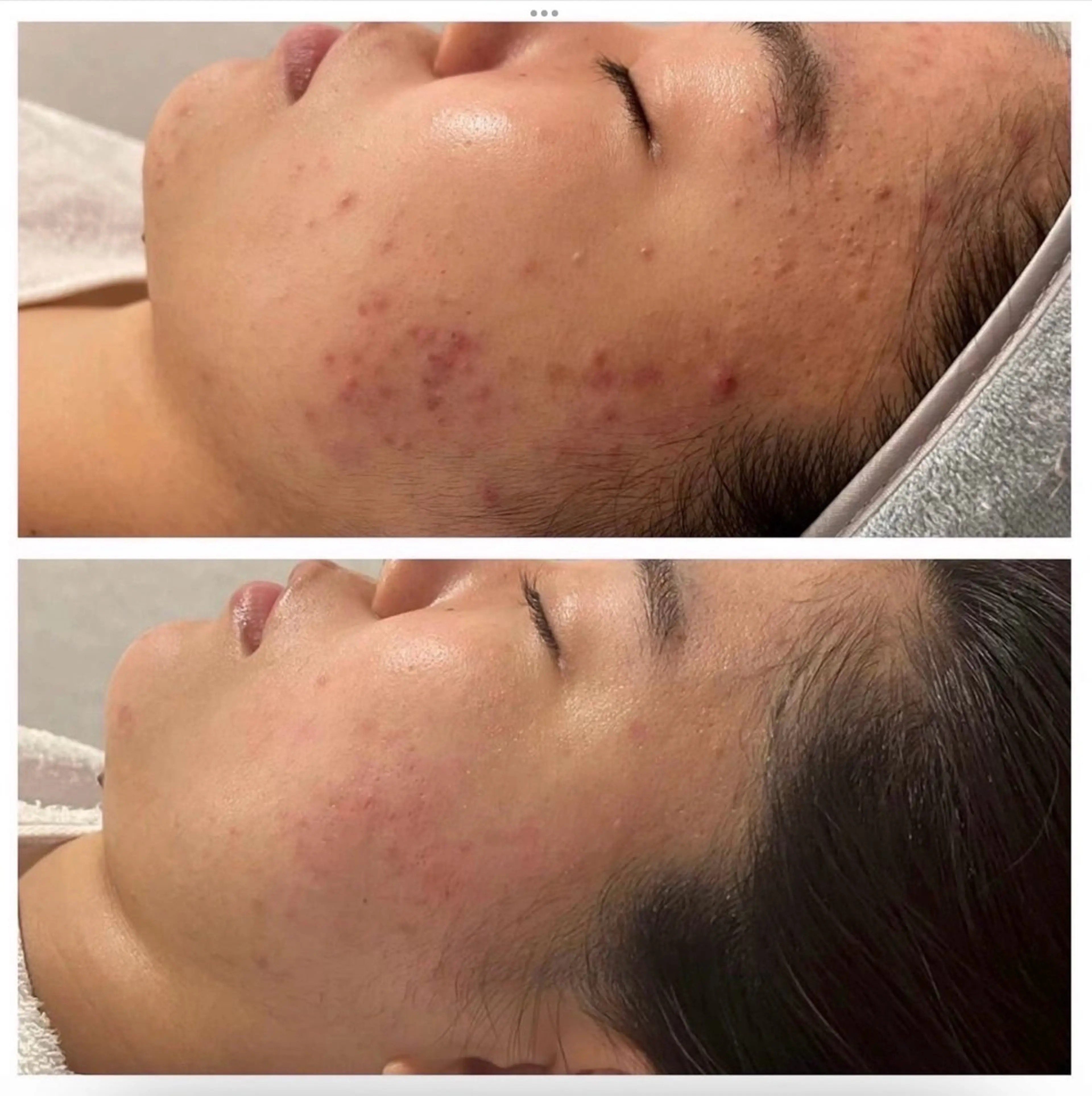 ニキビ跡アンプルで気になるニキビ跡やシミを撃退!の写真