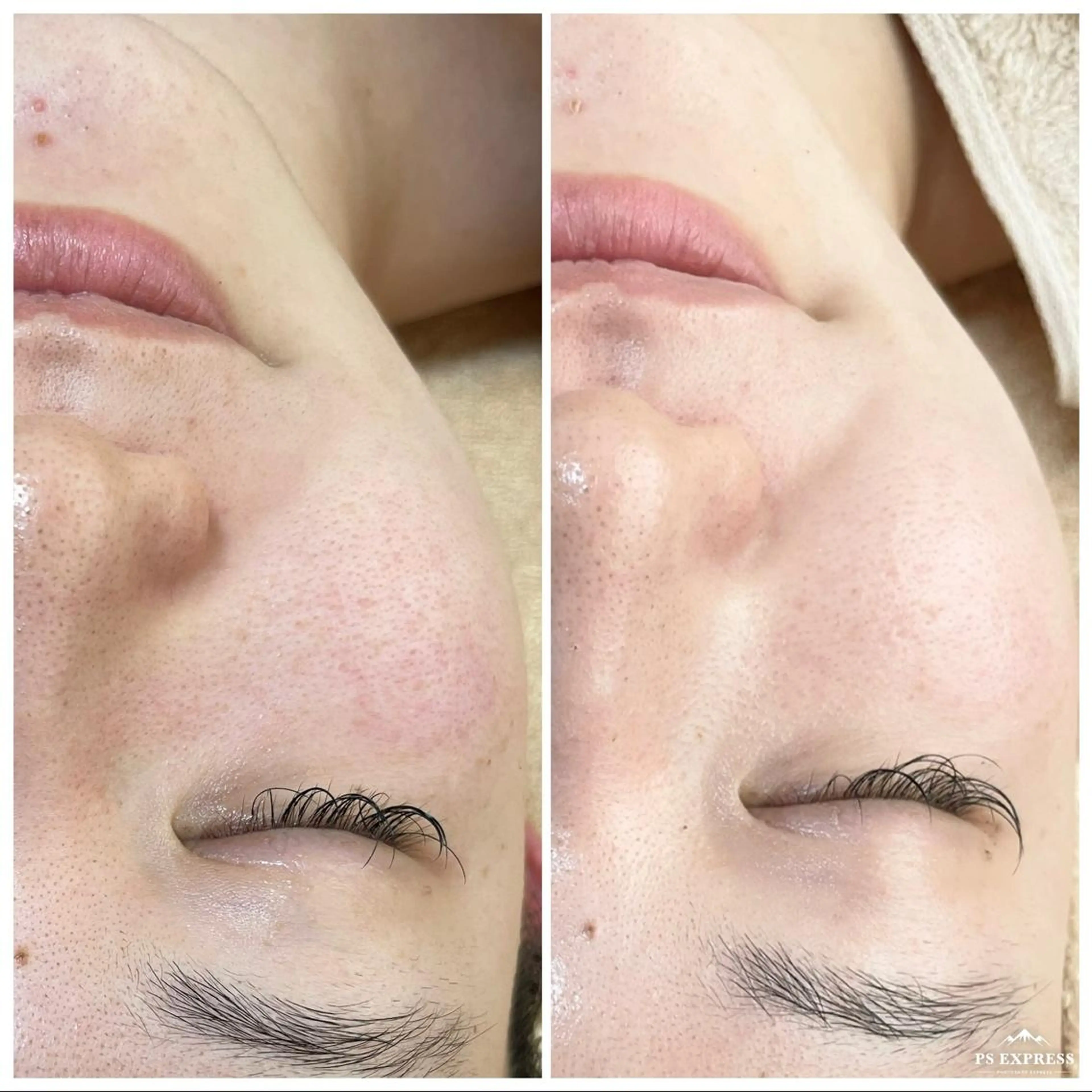 マツエク・マツパ エステ ニキビ・毛穴改善 🌿ハーブピーリングのエステ・リラクイメージ