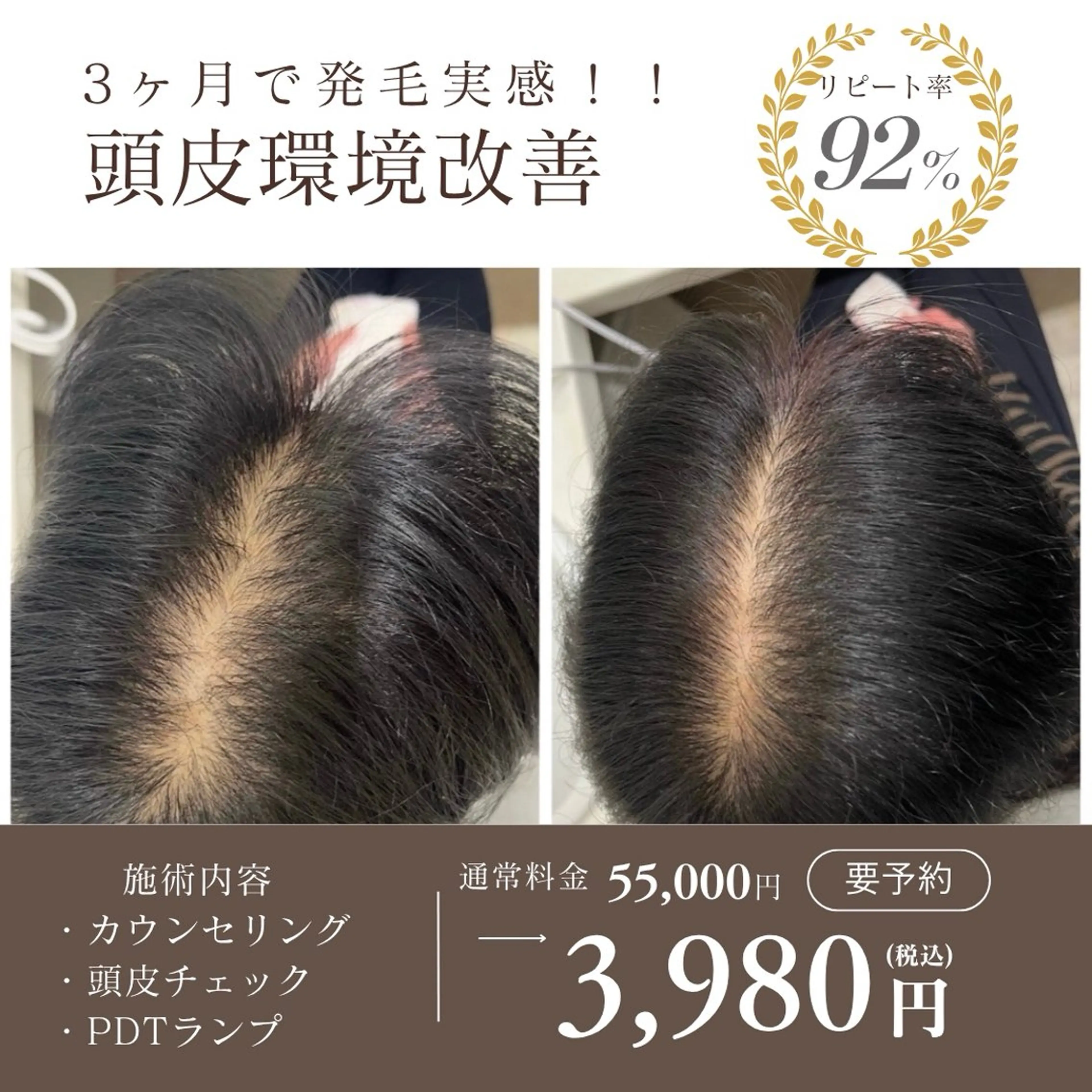 本気の育毛ケア‼️3ヶ月で発毛実感続出の写真