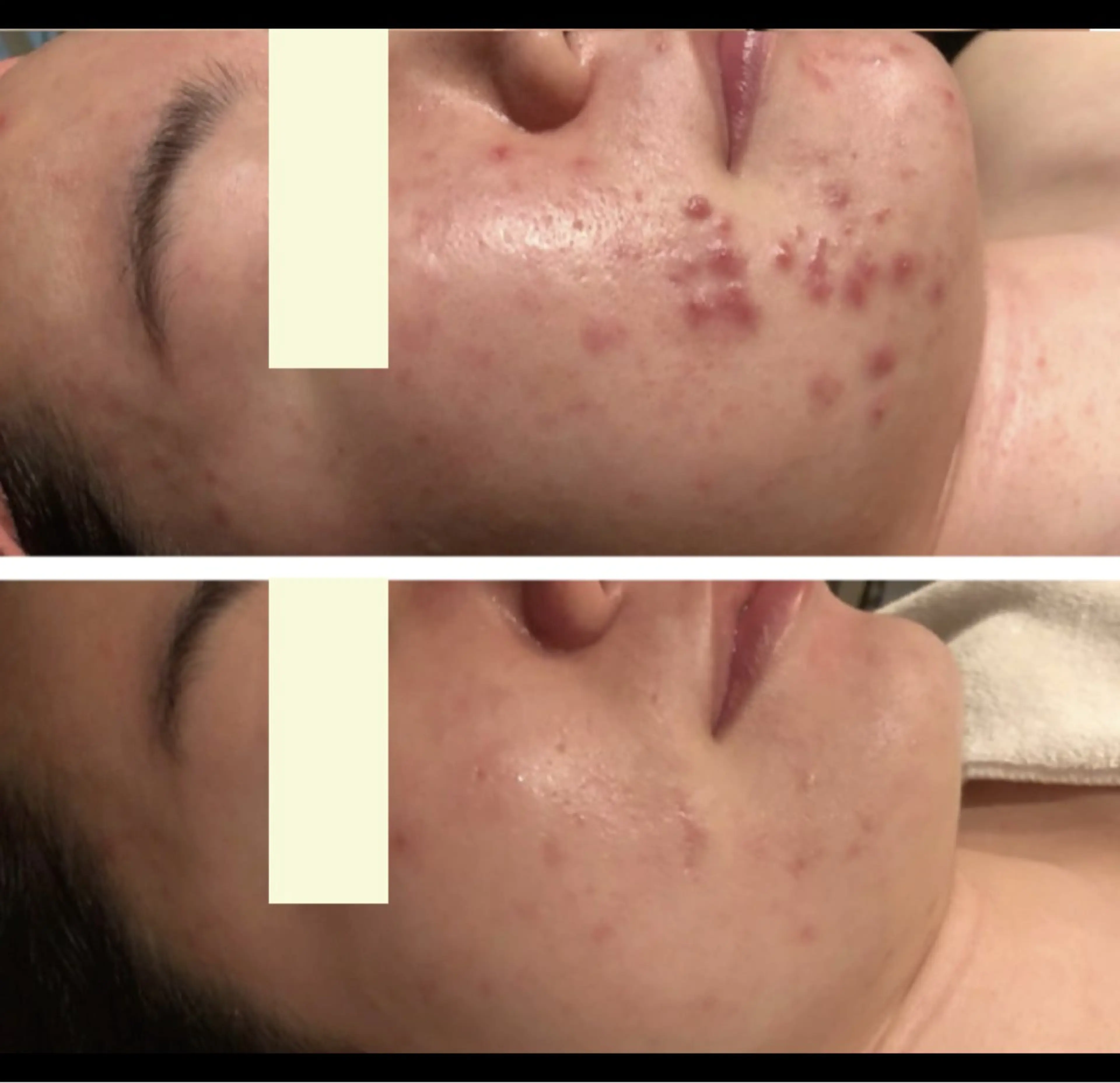 【毛穴洗浄モニター募集】5回19,900円→15,000円の写真