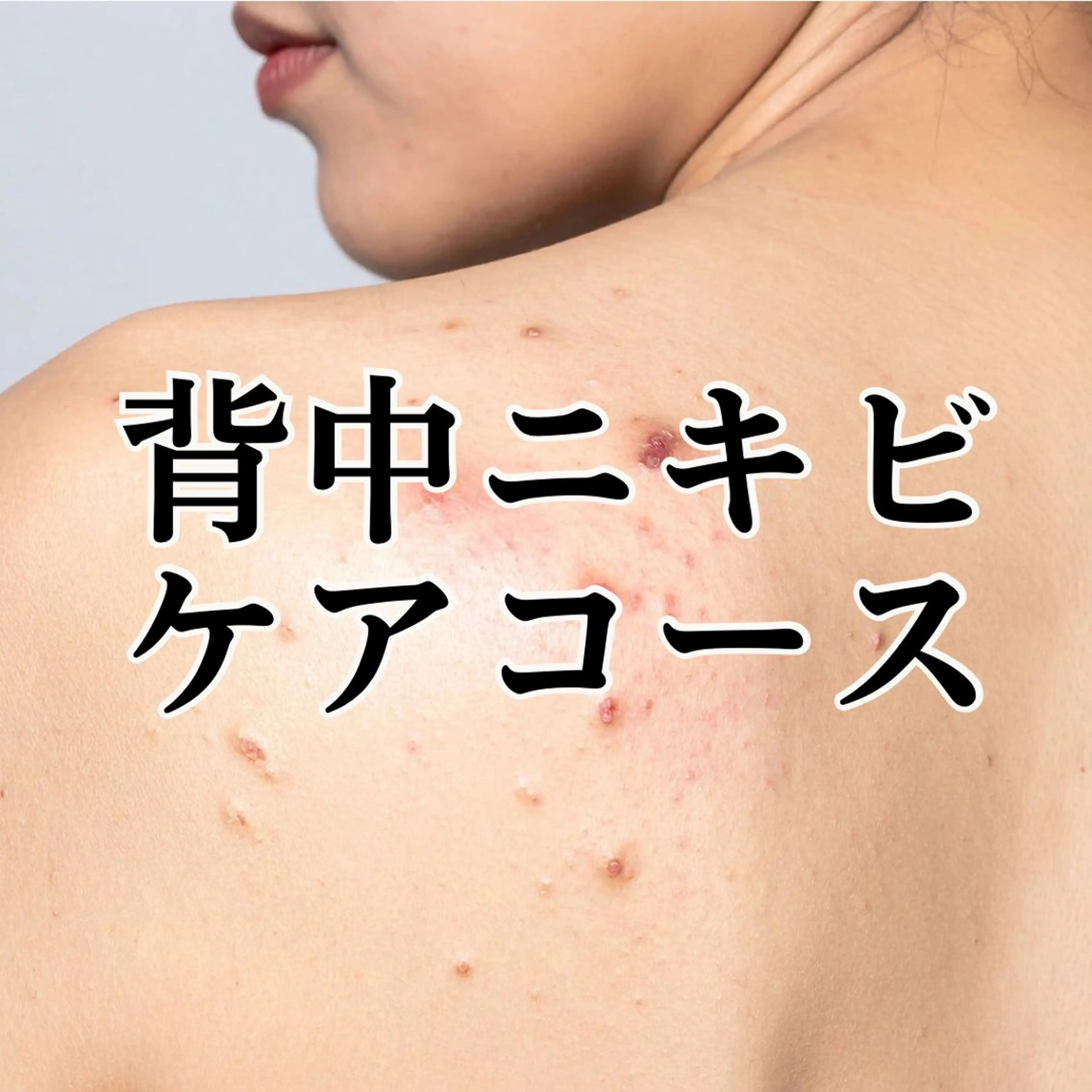 【背中ニキビ撃退】複数施術カスタムの写真